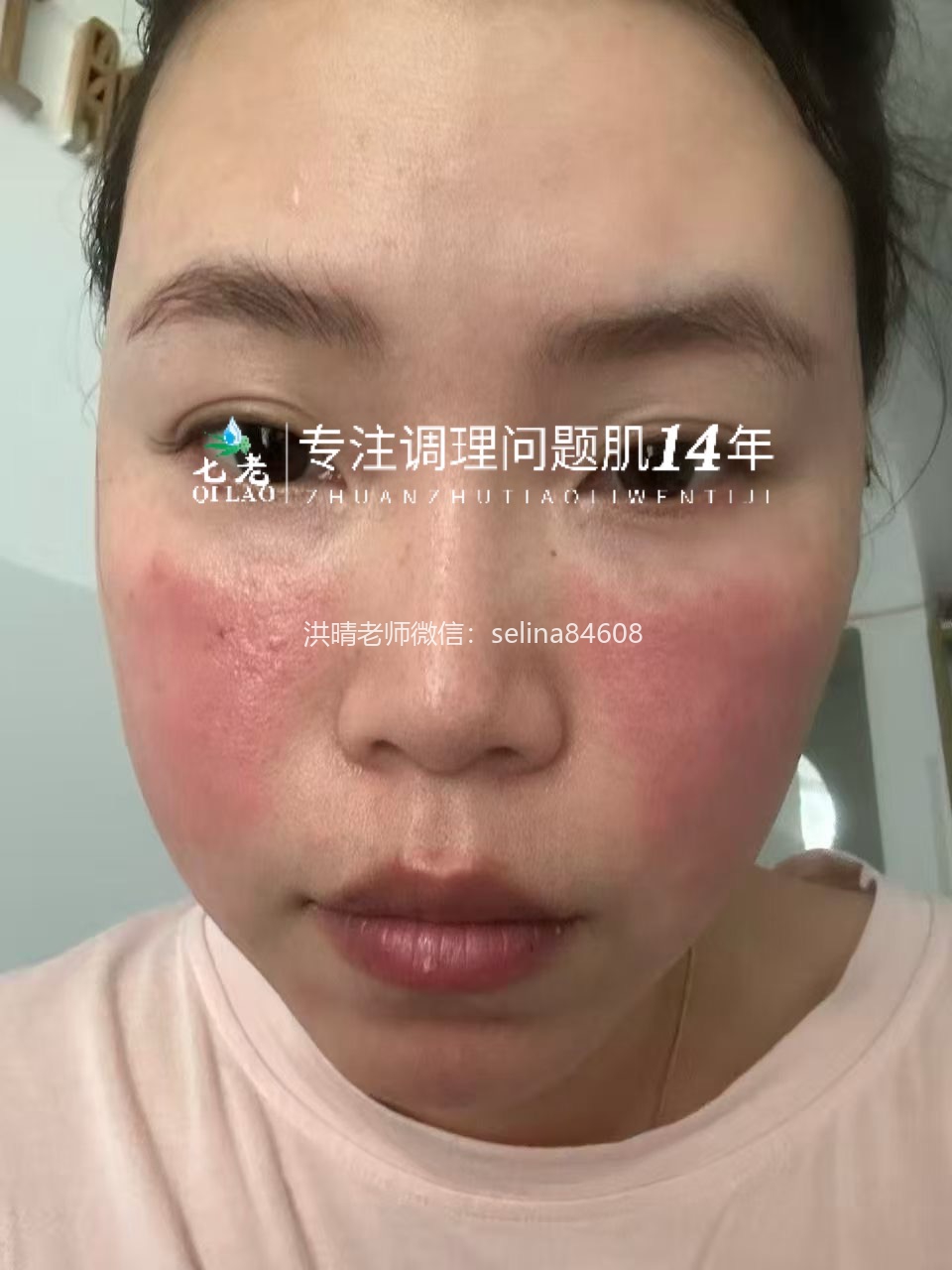 七老发红发烫红烫肌修护案例