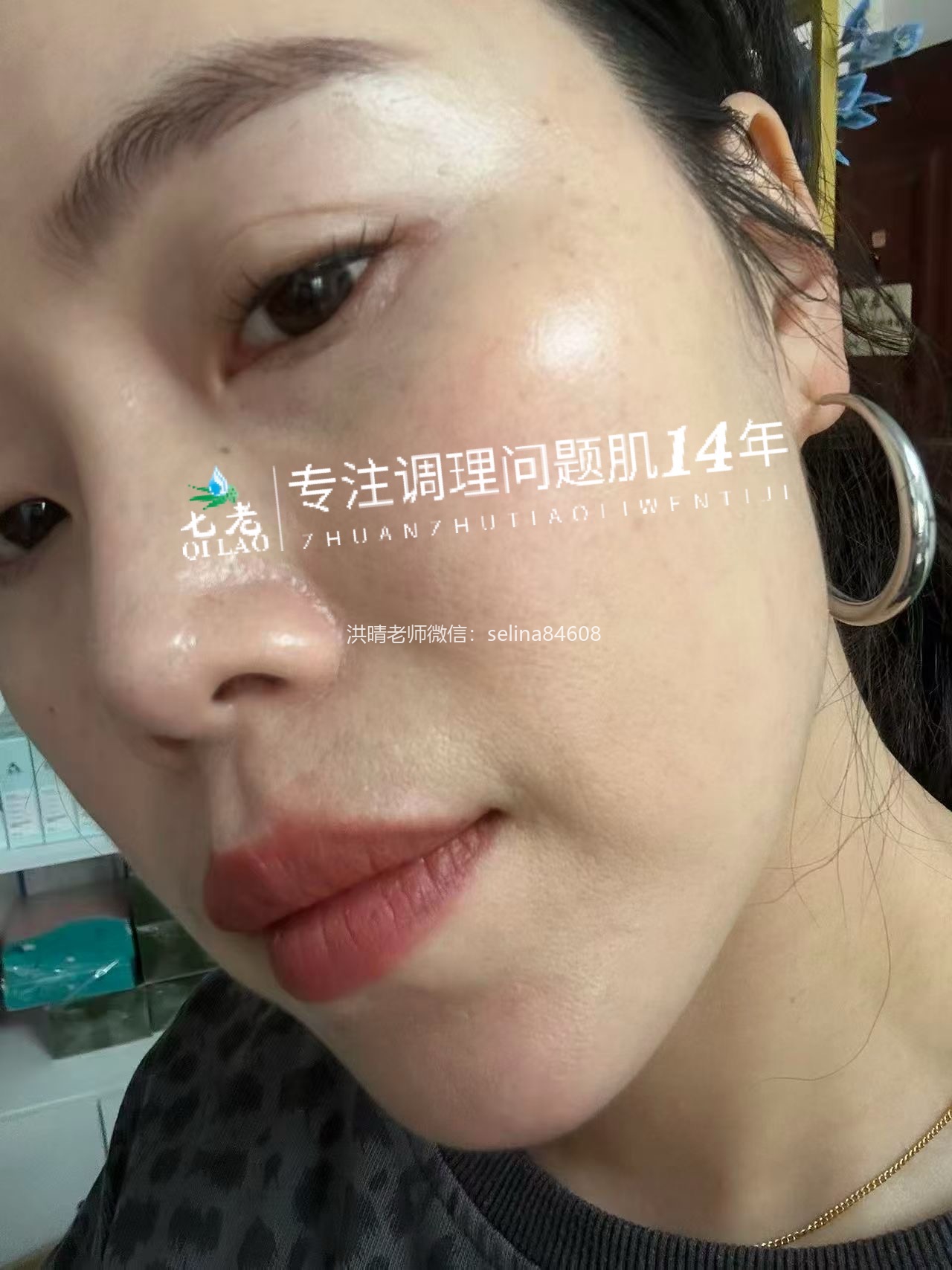 七老发红发烫红烫肌修护案例
