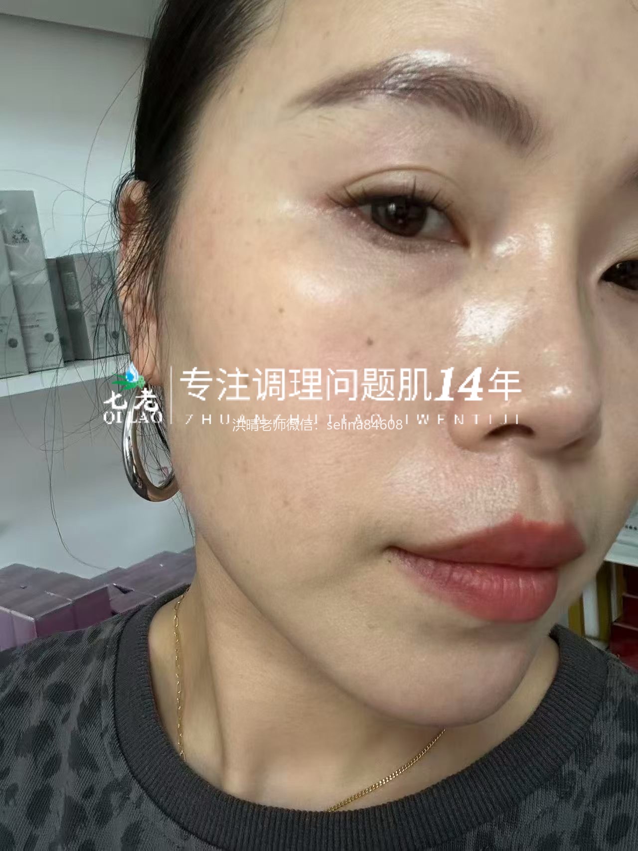 七老发红发烫红烫肌修护案例