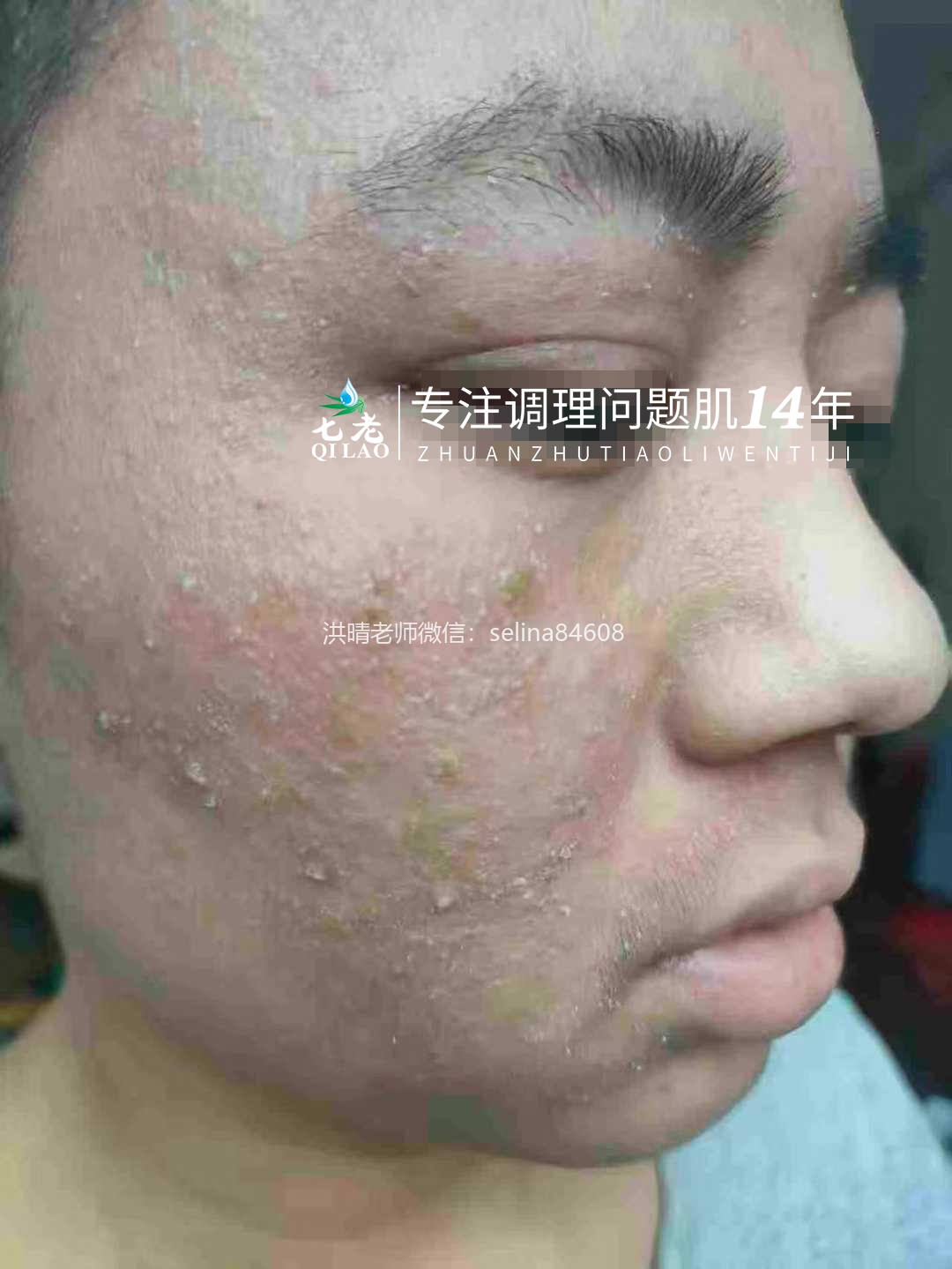 七老严重激素脸流黄水结痂渗液修护记录✍️