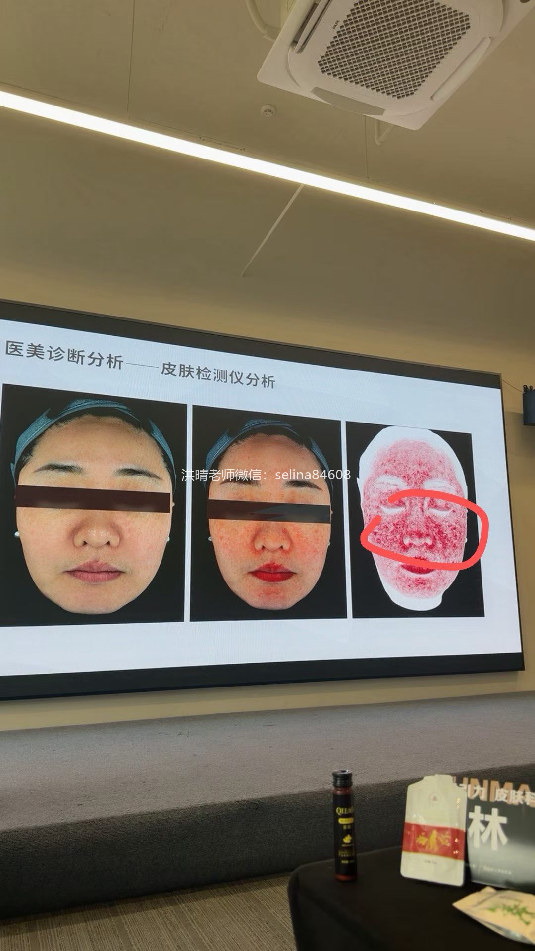 七老激素脸，玫瑰皮，脂皮，皮肤修护过程中为什么让你一定要抗炎，调理内在的慢性炎症水平