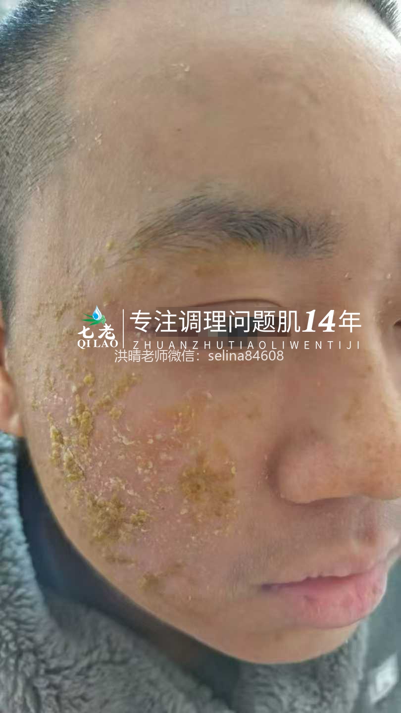 七老严重激素脸流黄水结痂渗液修护记录✍️
