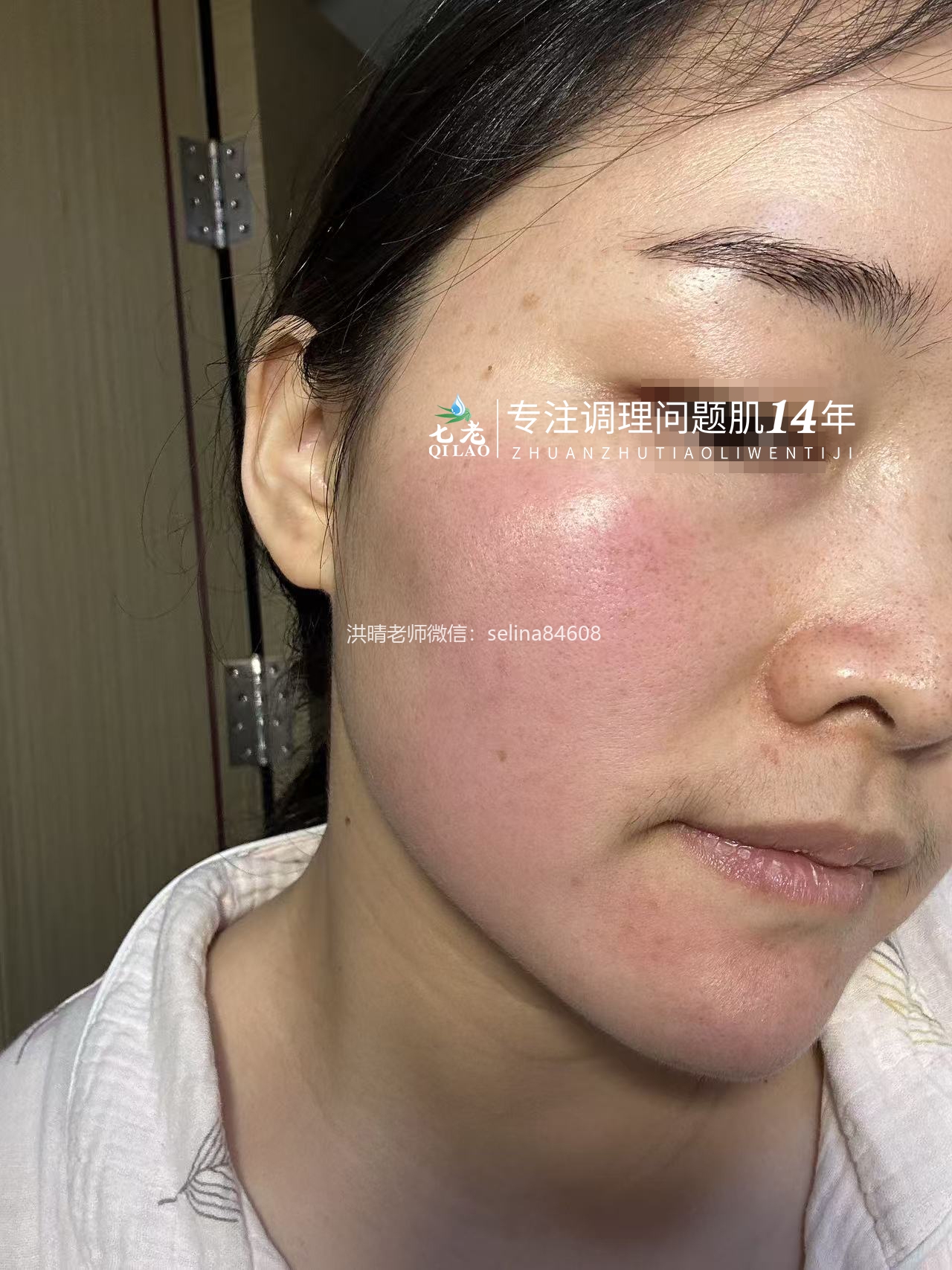 七老屏障受损敏感过敏红肿痒修护案例