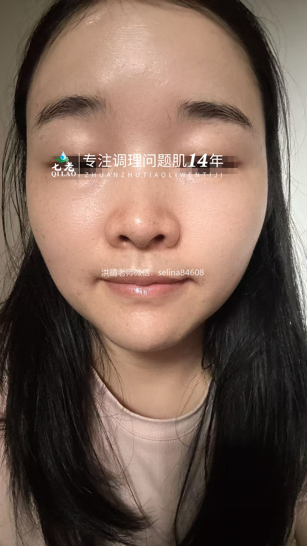 七老屏障受损敏感过敏红肿痒修护案例