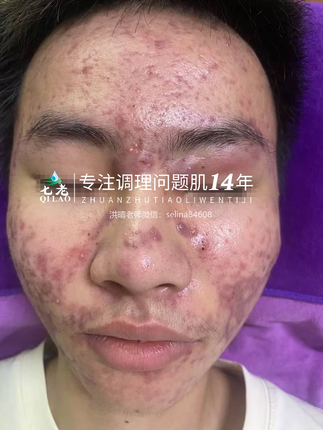 七老激素痘囊肿脓包痘痤疮痘修护案例