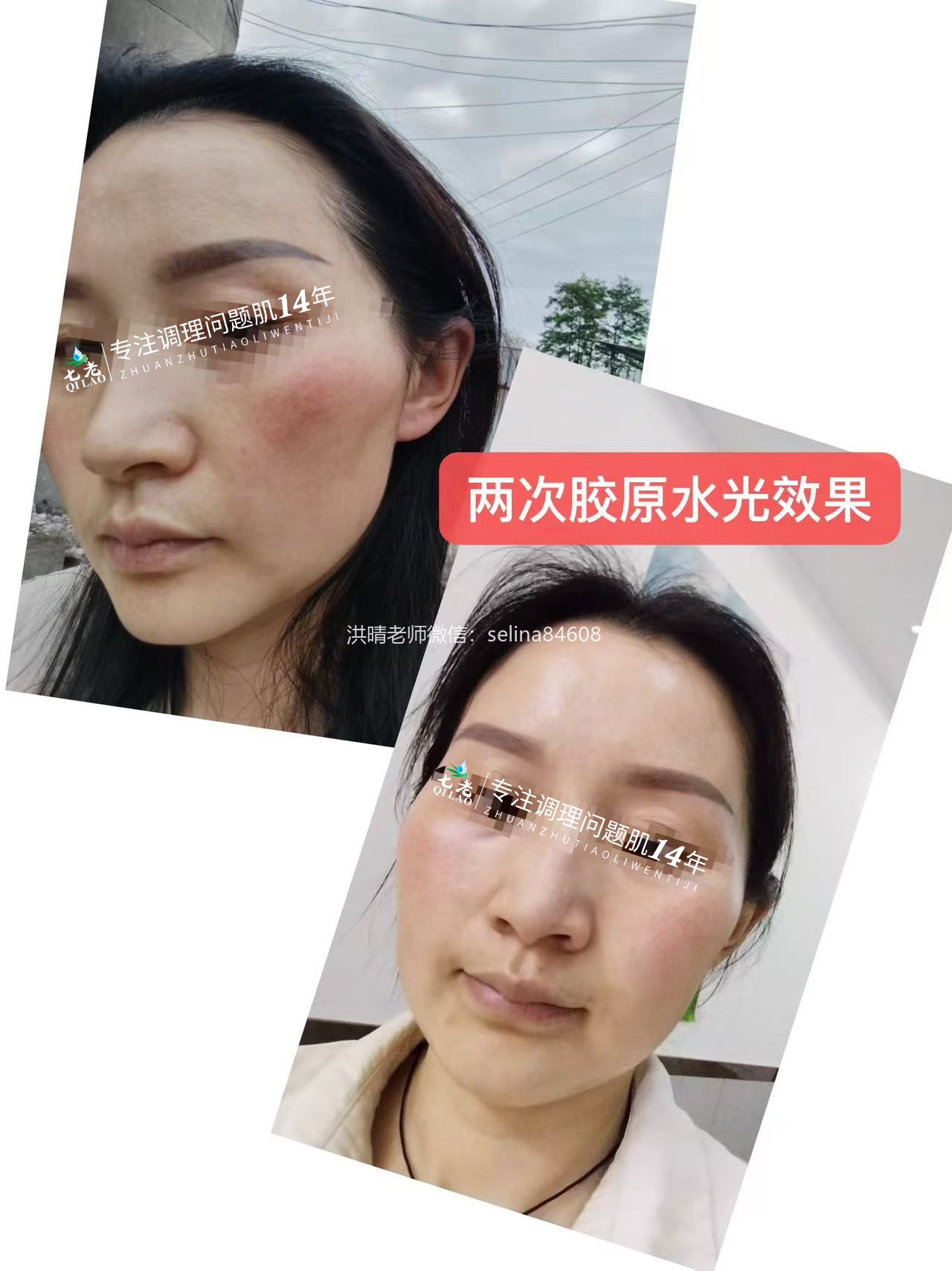 七老居家胶原水光，用了你就会爱上