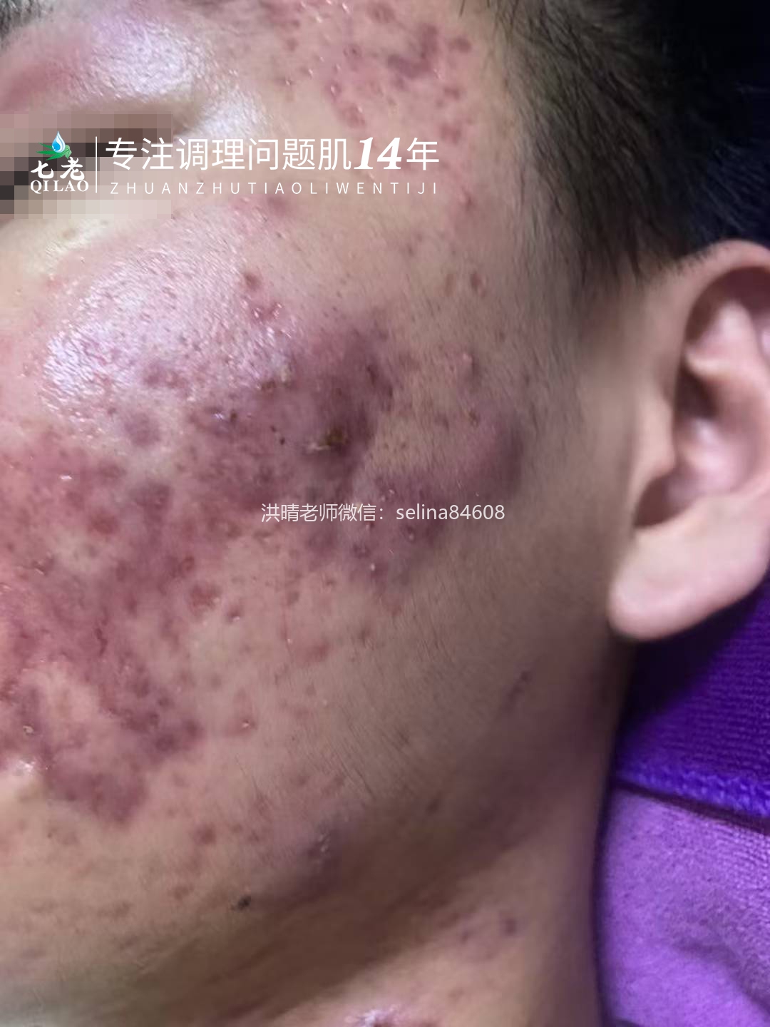七老激素痘囊肿脓包痘痤疮痘修护案例