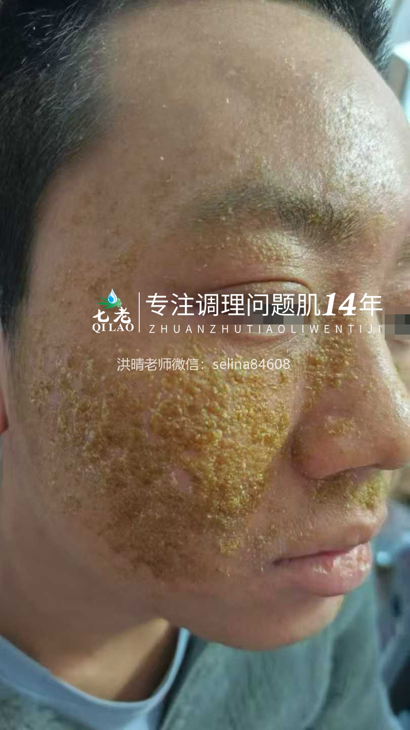 七老严重激素脸流黄水结痂渗液修护记录✍️