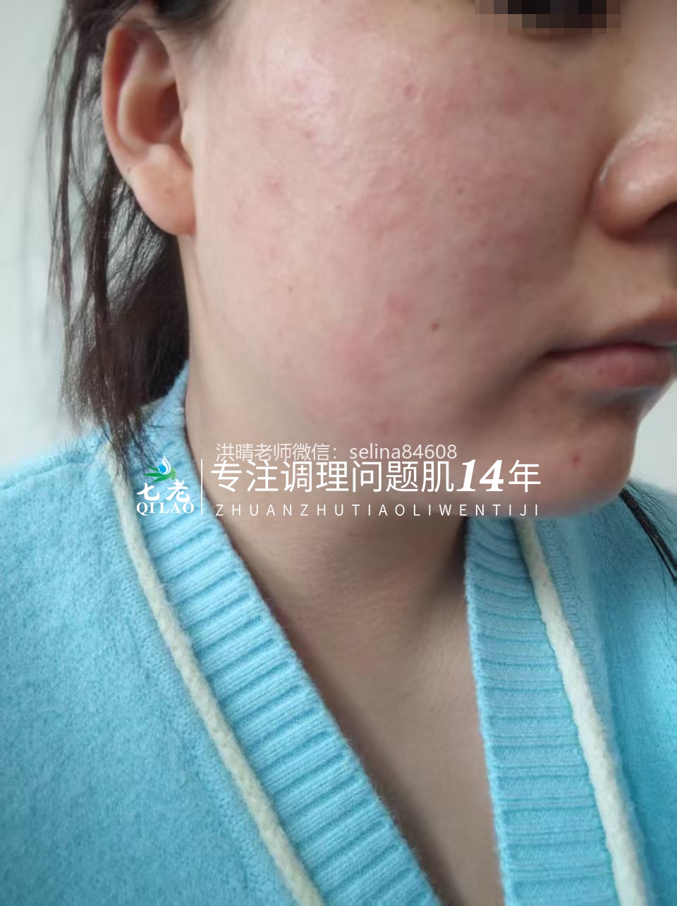 七老激素脸红烫痒疹子疙瘩修护案例