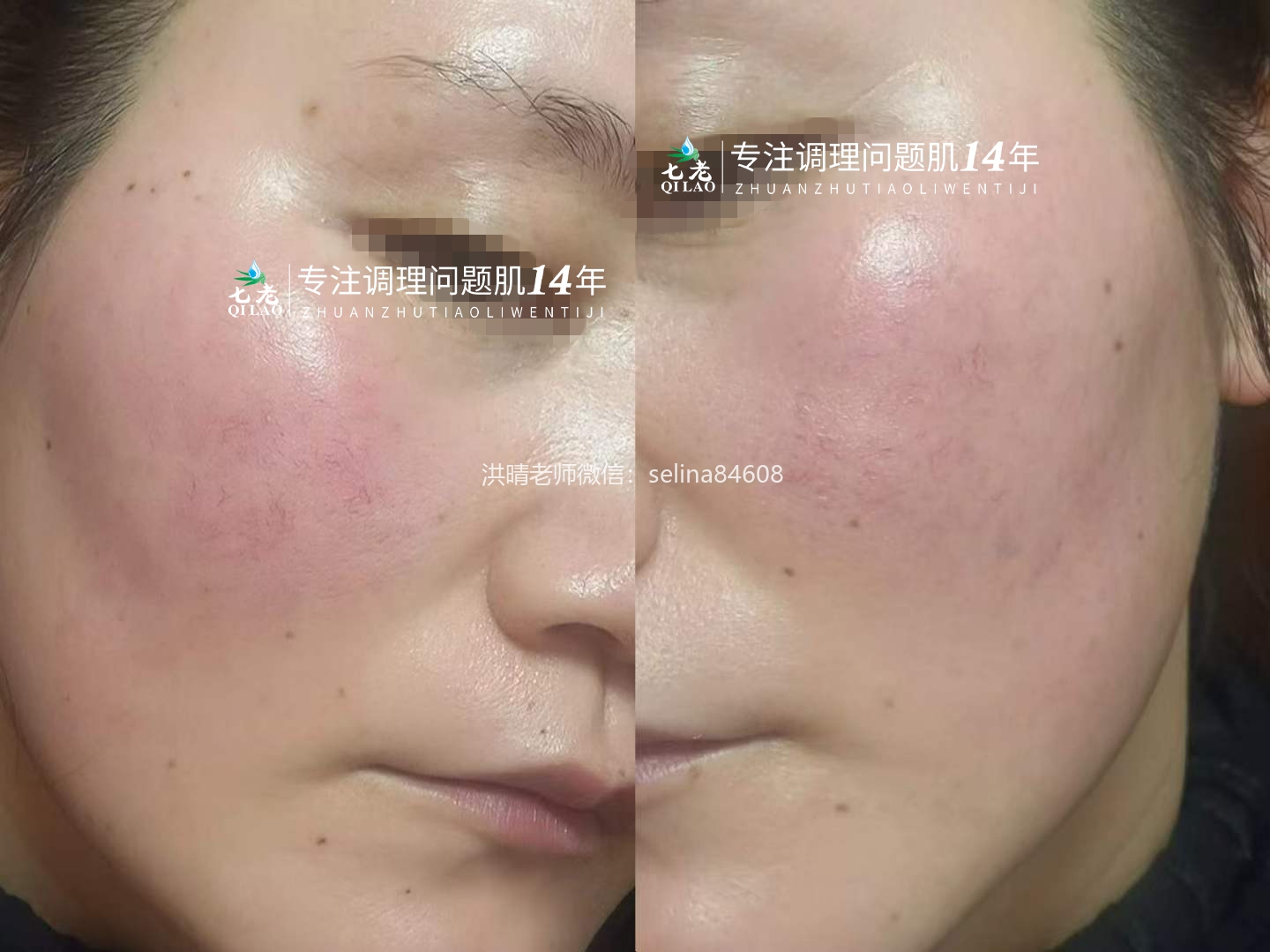 七老激素脸玫瑰痤疮修护案例