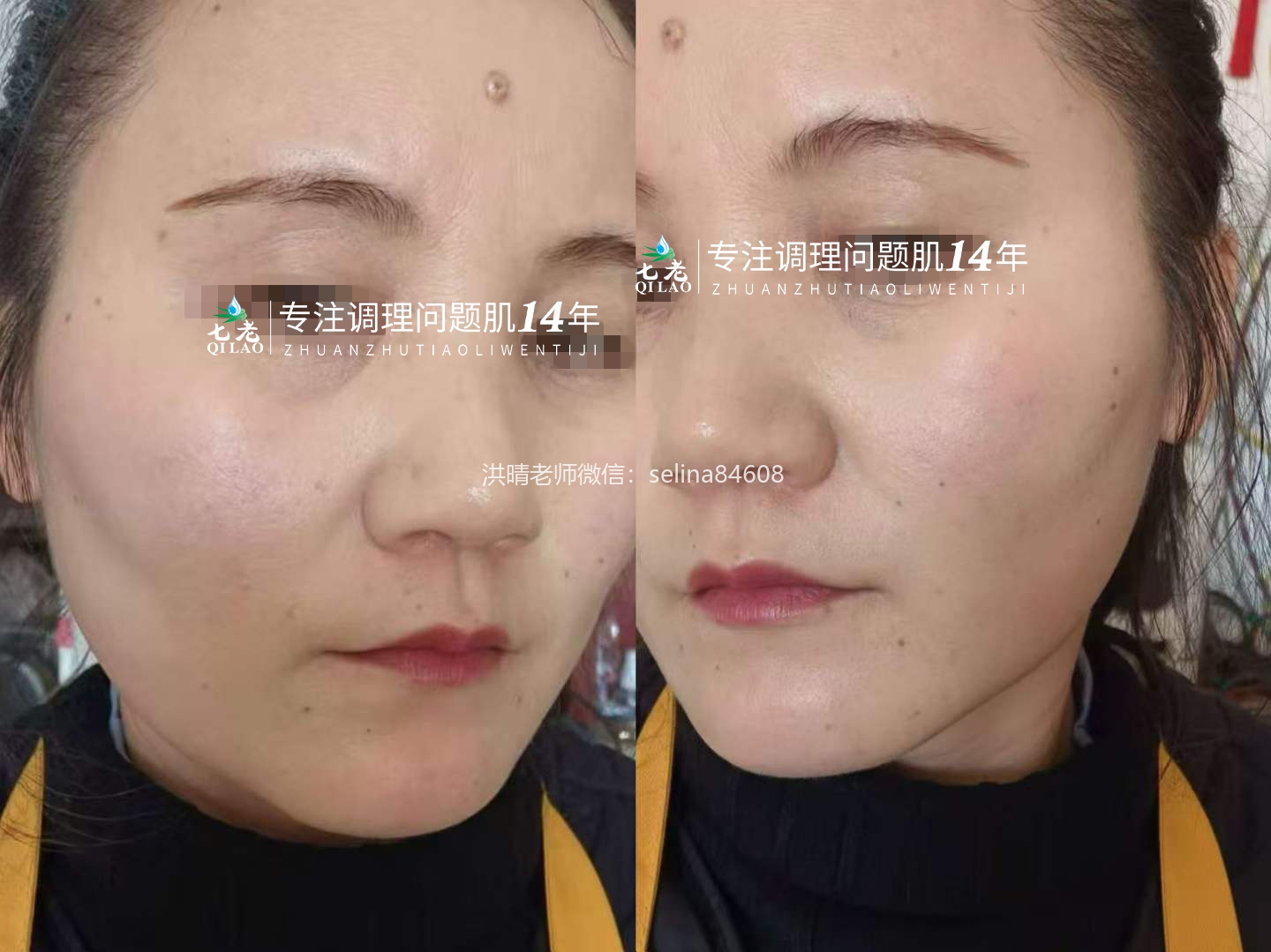 七老激素脸玫瑰痤疮修护案例
