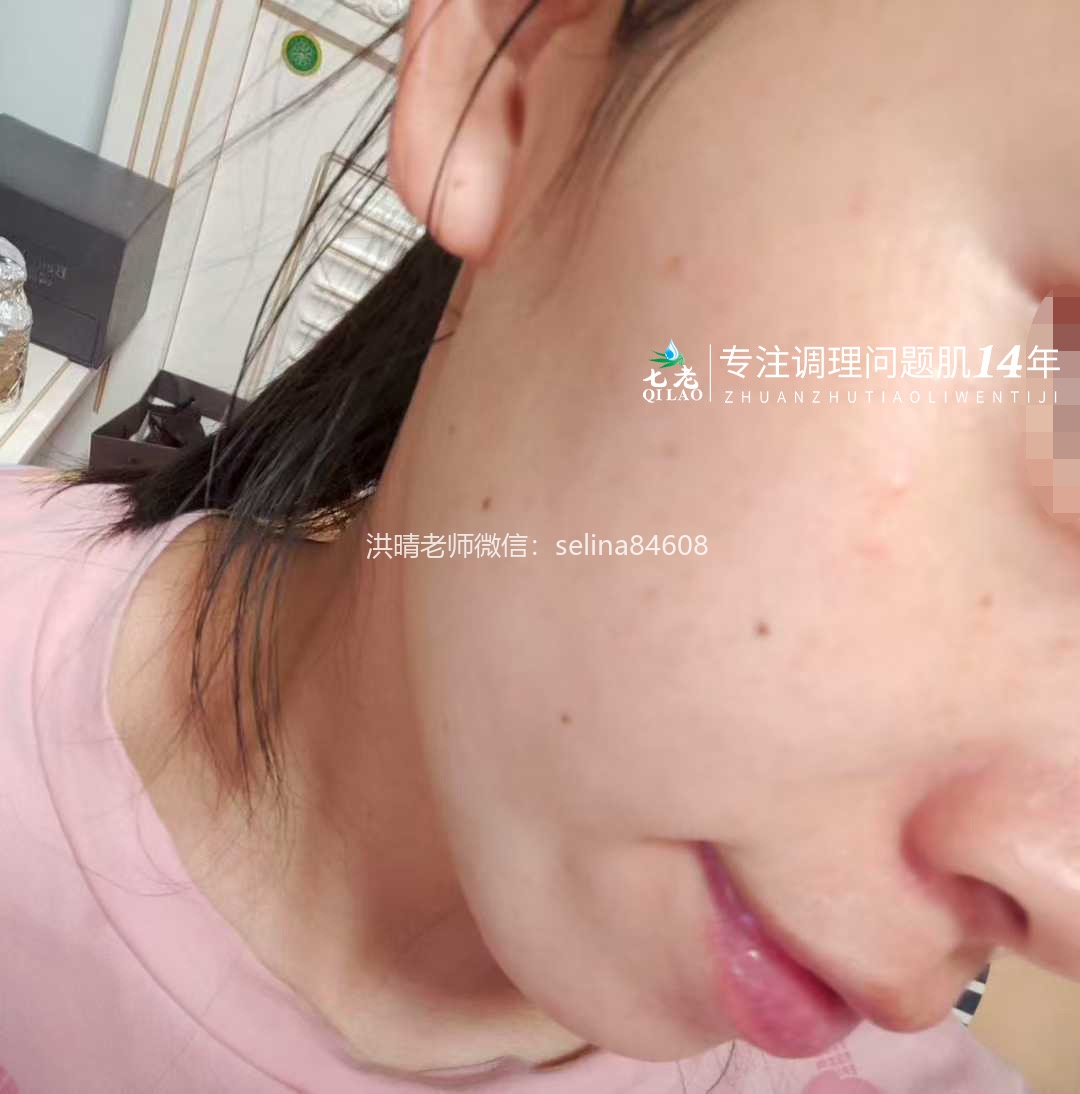 七老敏感过敏发红发烫起疹子修护案例