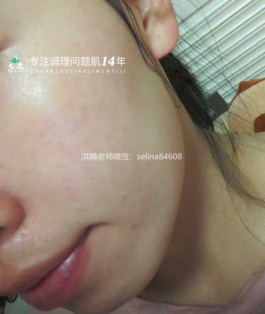 七老敏感过敏发红发烫起疹子修护案例