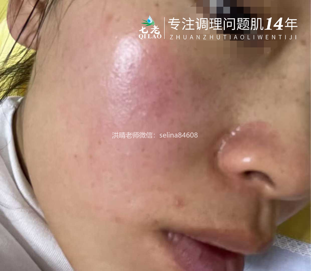 七老敏感过敏发红发烫起疹子修护案例