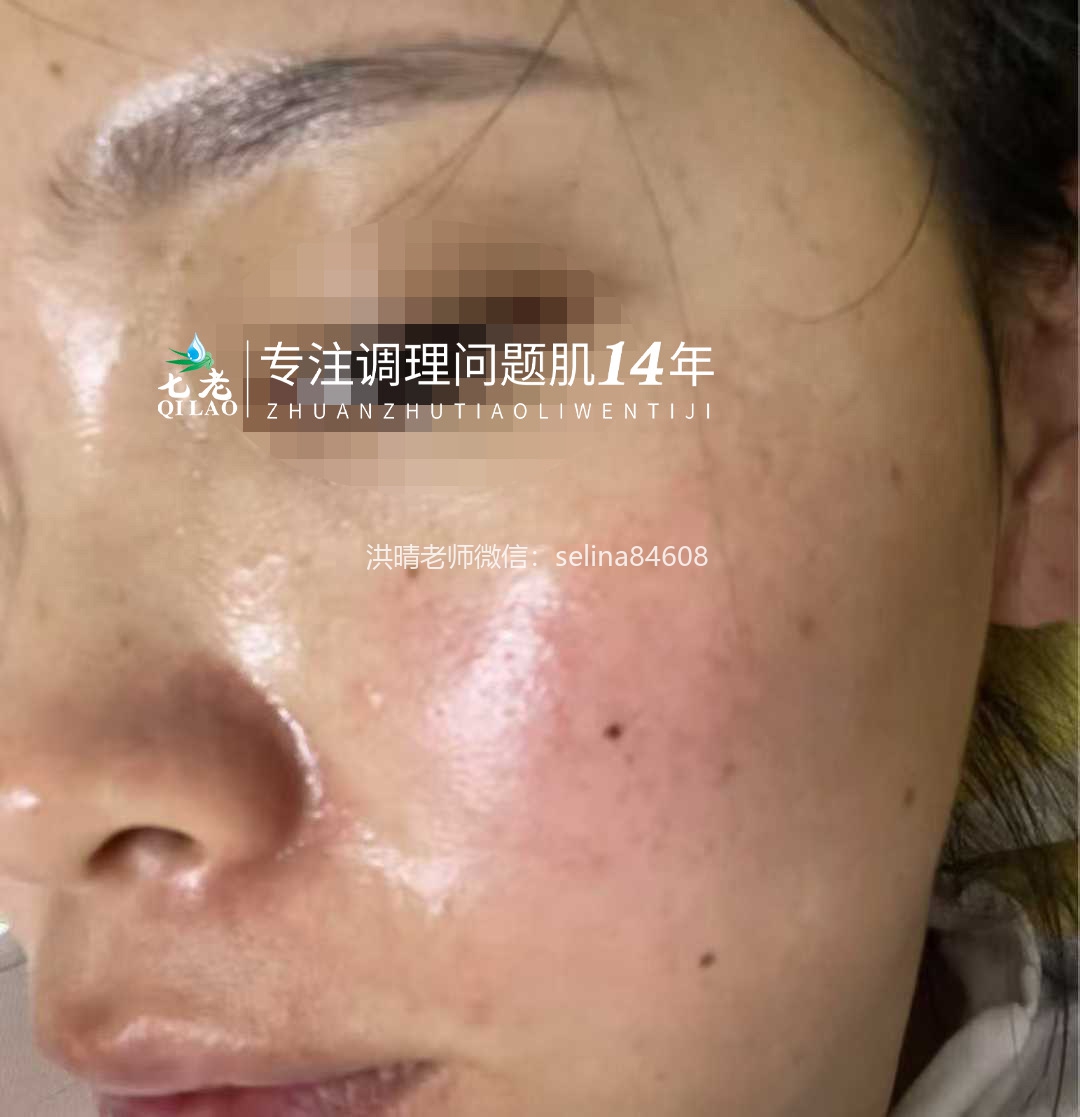 七老敏感过敏发红发烫起疹子修护案例