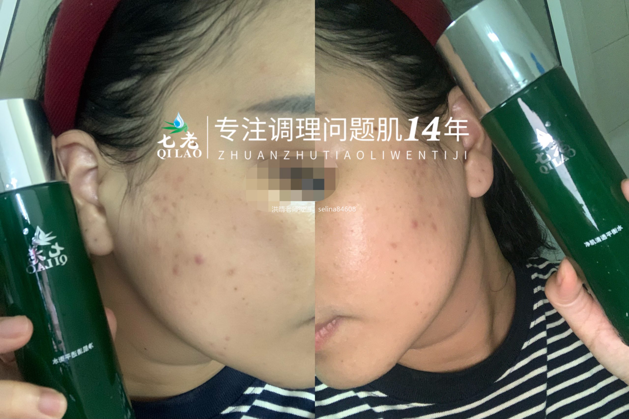 七老痘痘肌痘印修护案例反馈
