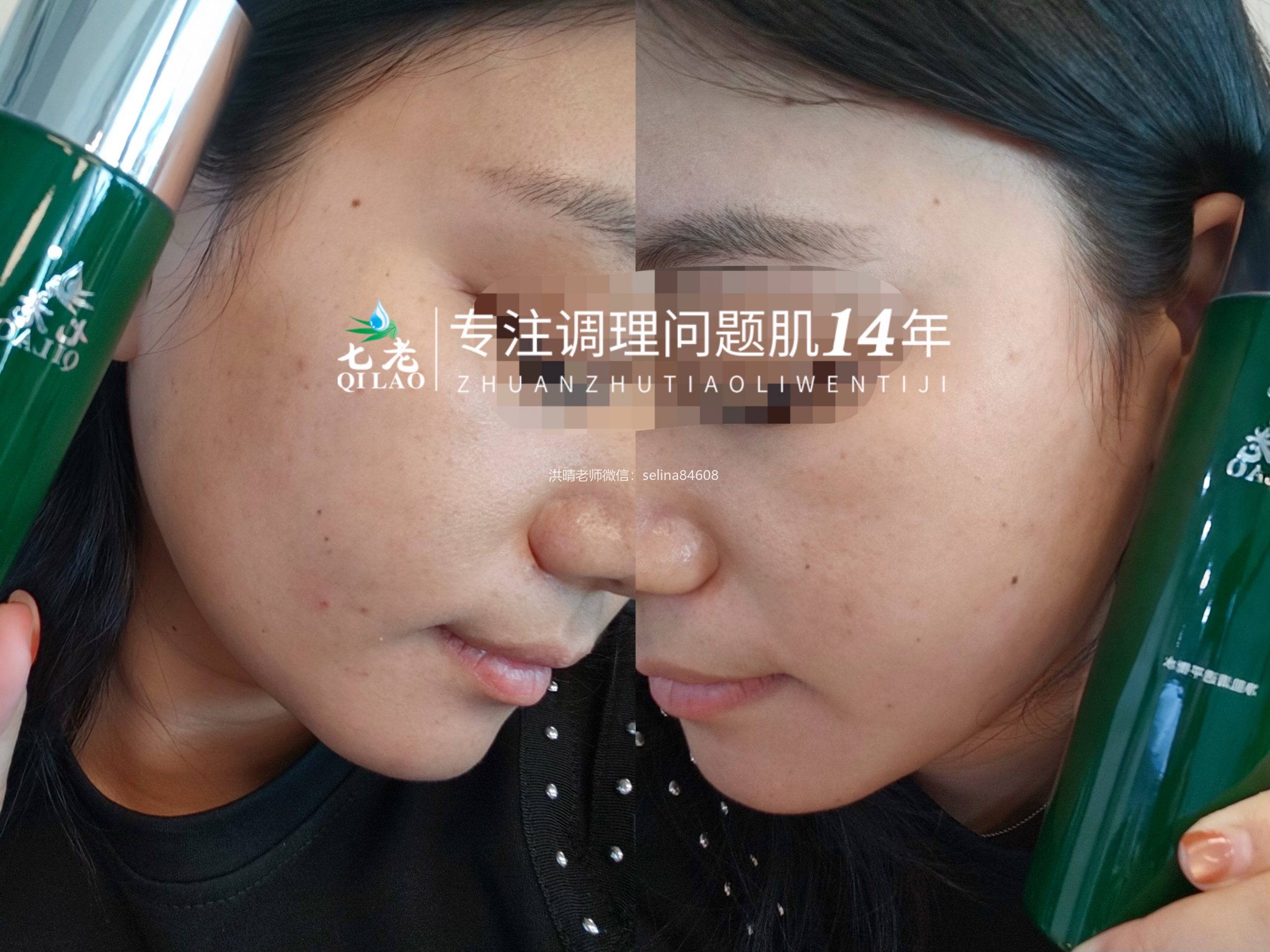 七老痘痘肌痘印修护案例反馈