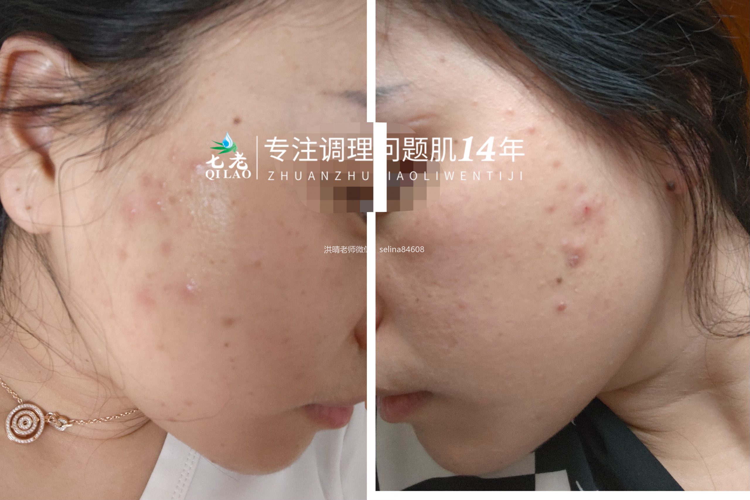 七老痘痘肌痘印修护案例反馈