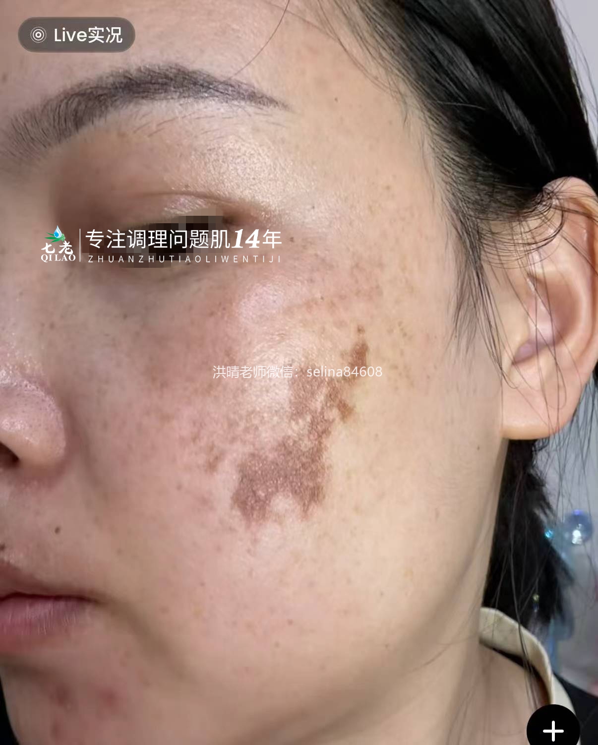 七老传明酸→黑红脸红黑脸色沉暗黄暗沉肤色不均