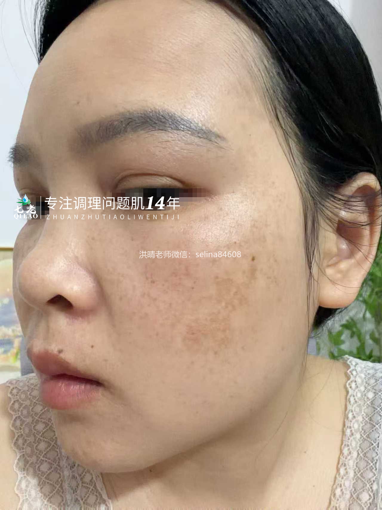 七老传明酸→黑红脸红黑脸色沉暗黄暗沉肤色不均