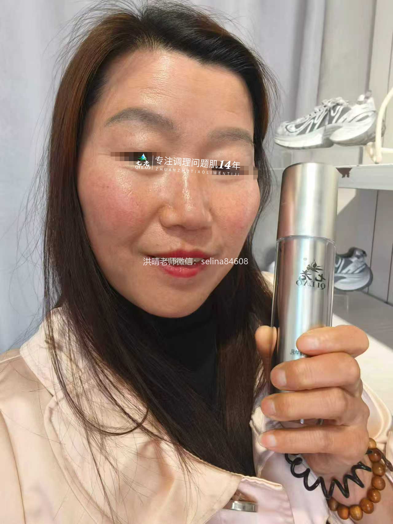 七老激素脸玫瑰痤疮烂脸修护案例