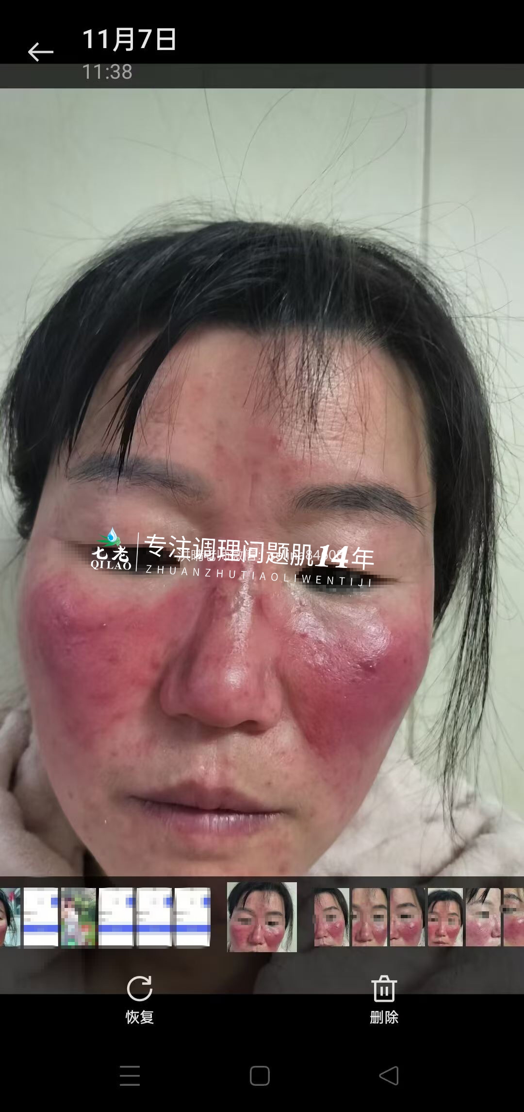 七老激素脸玫瑰痤疮烂脸修护案例