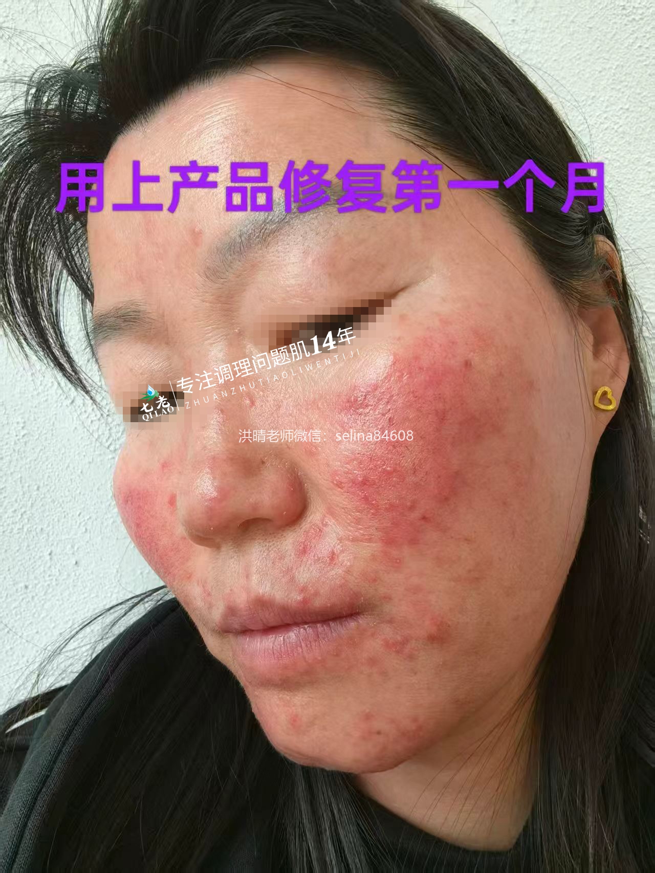 七老激素脸玫瑰痤疮烂脸修护案例