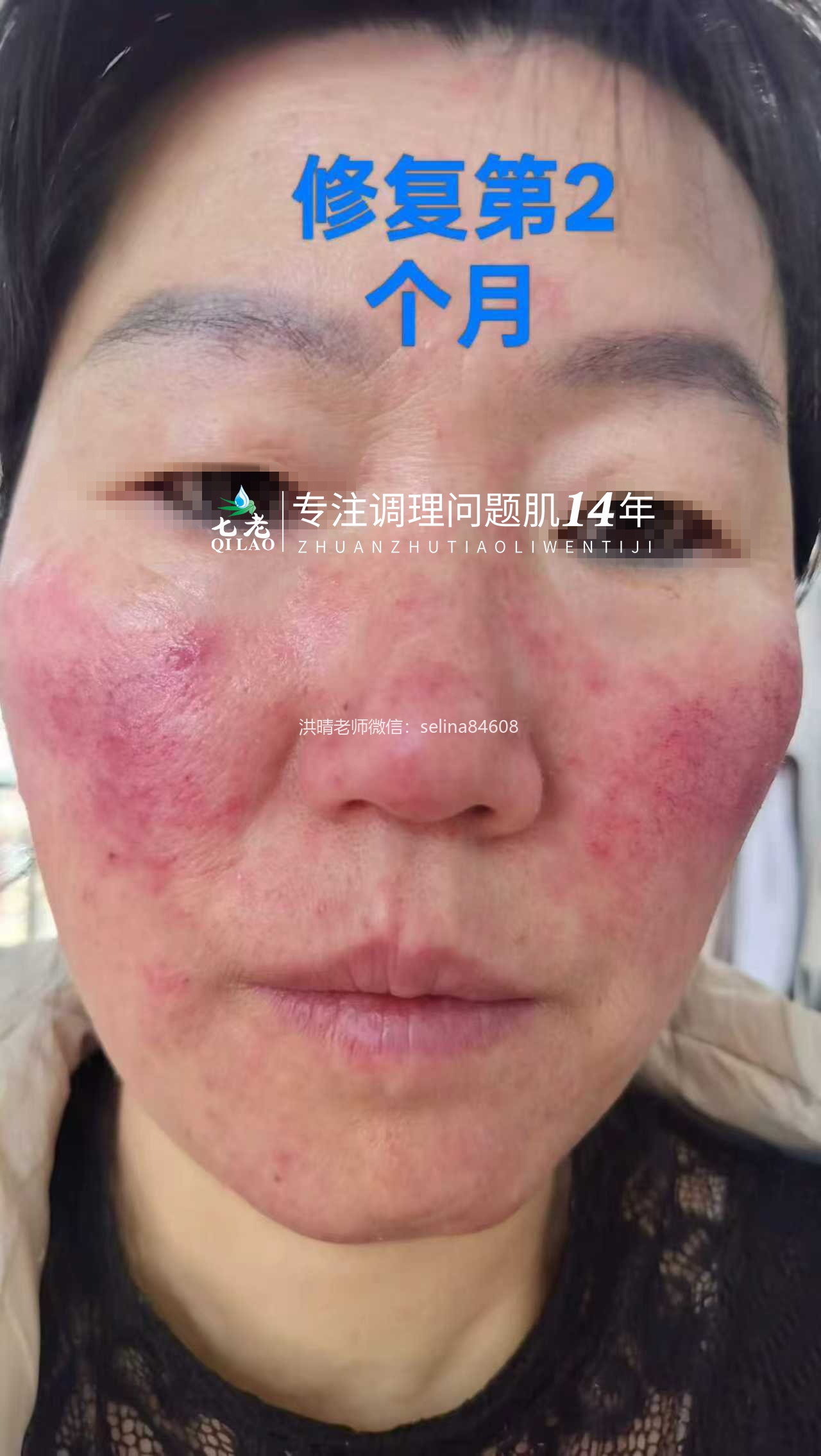 七老激素脸玫瑰痤疮烂脸修护案例