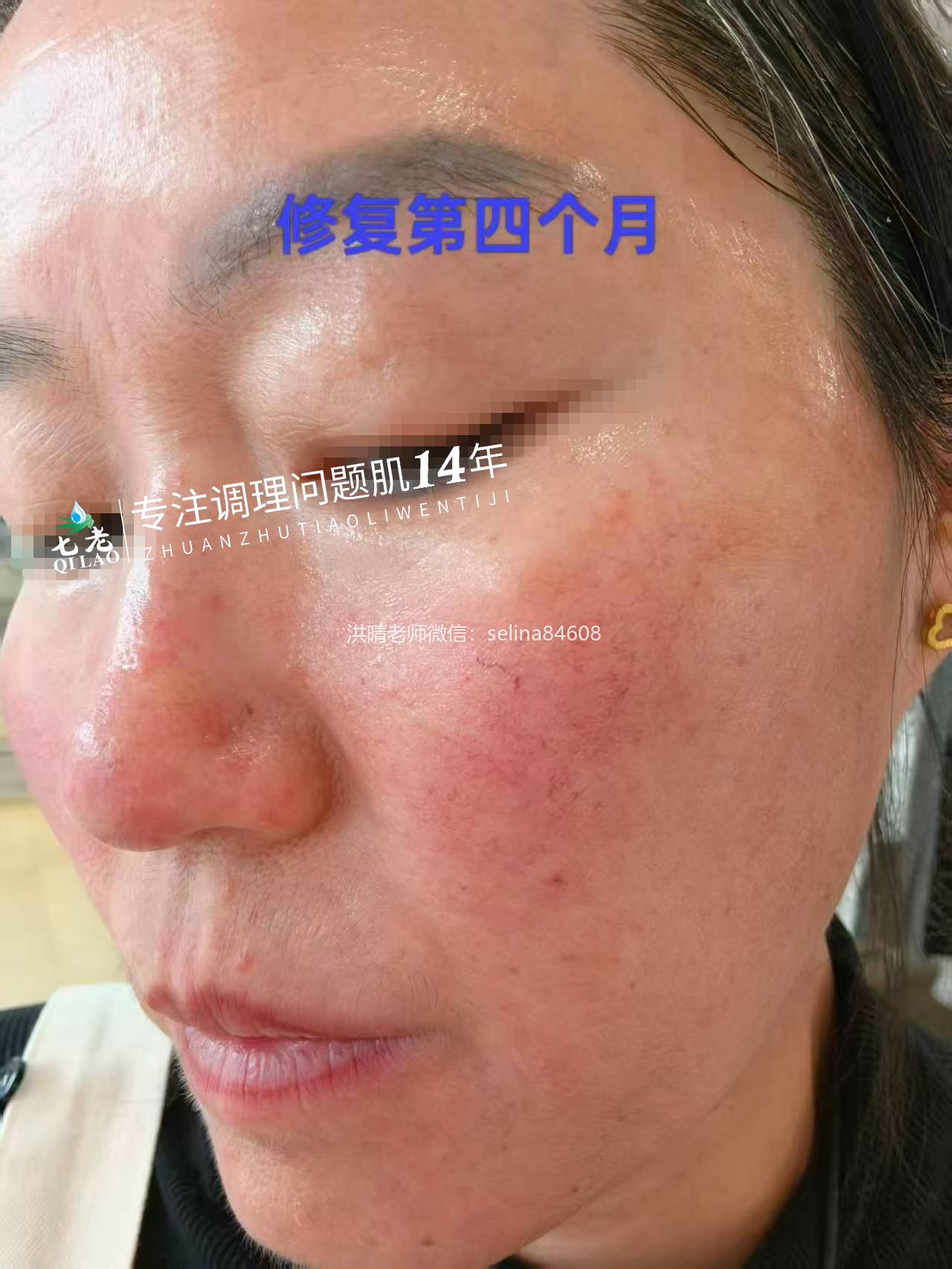 七老激素脸玫瑰痤疮烂脸修护案例