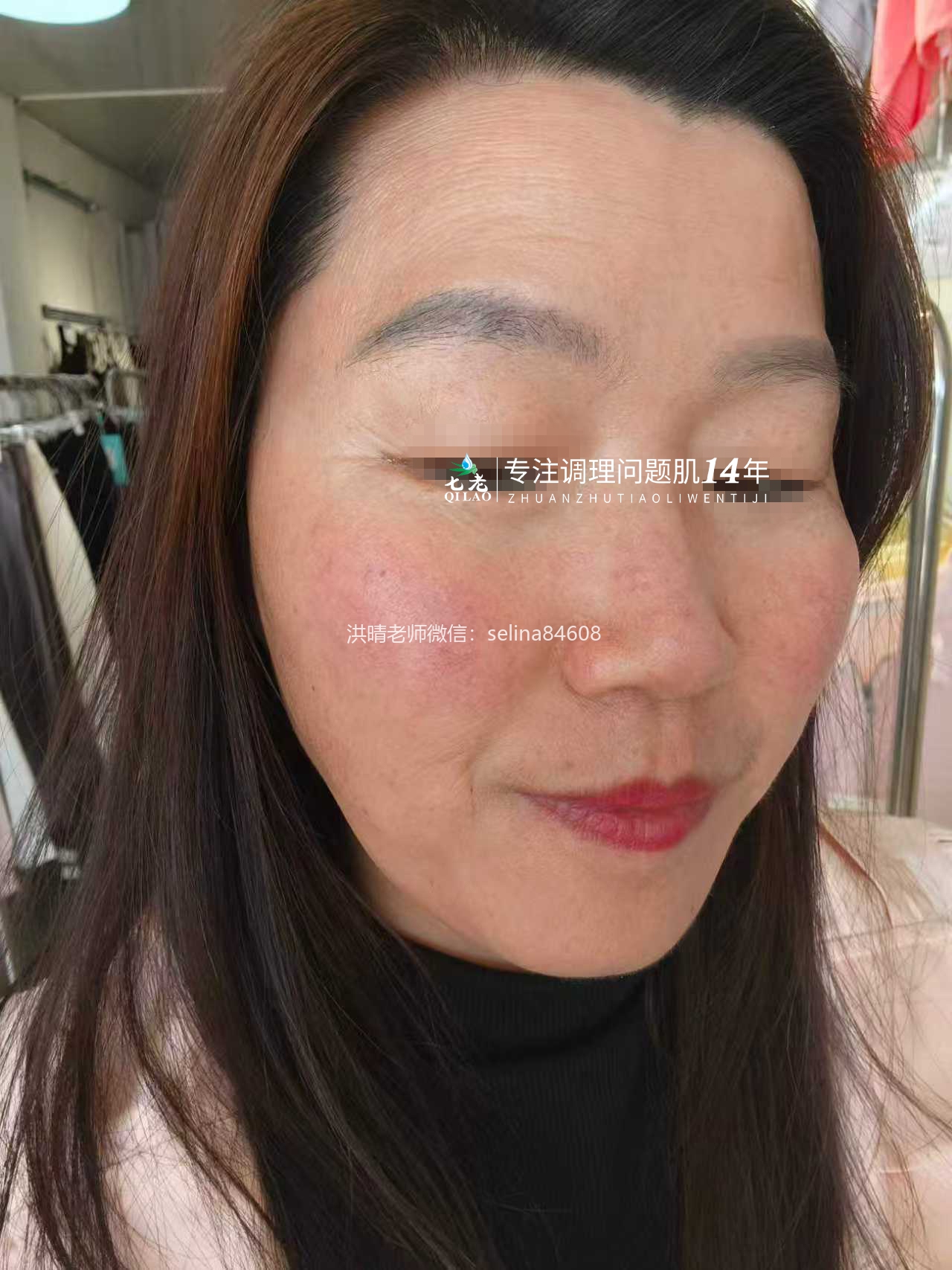 七老激素脸玫瑰痤疮烂脸修护案例