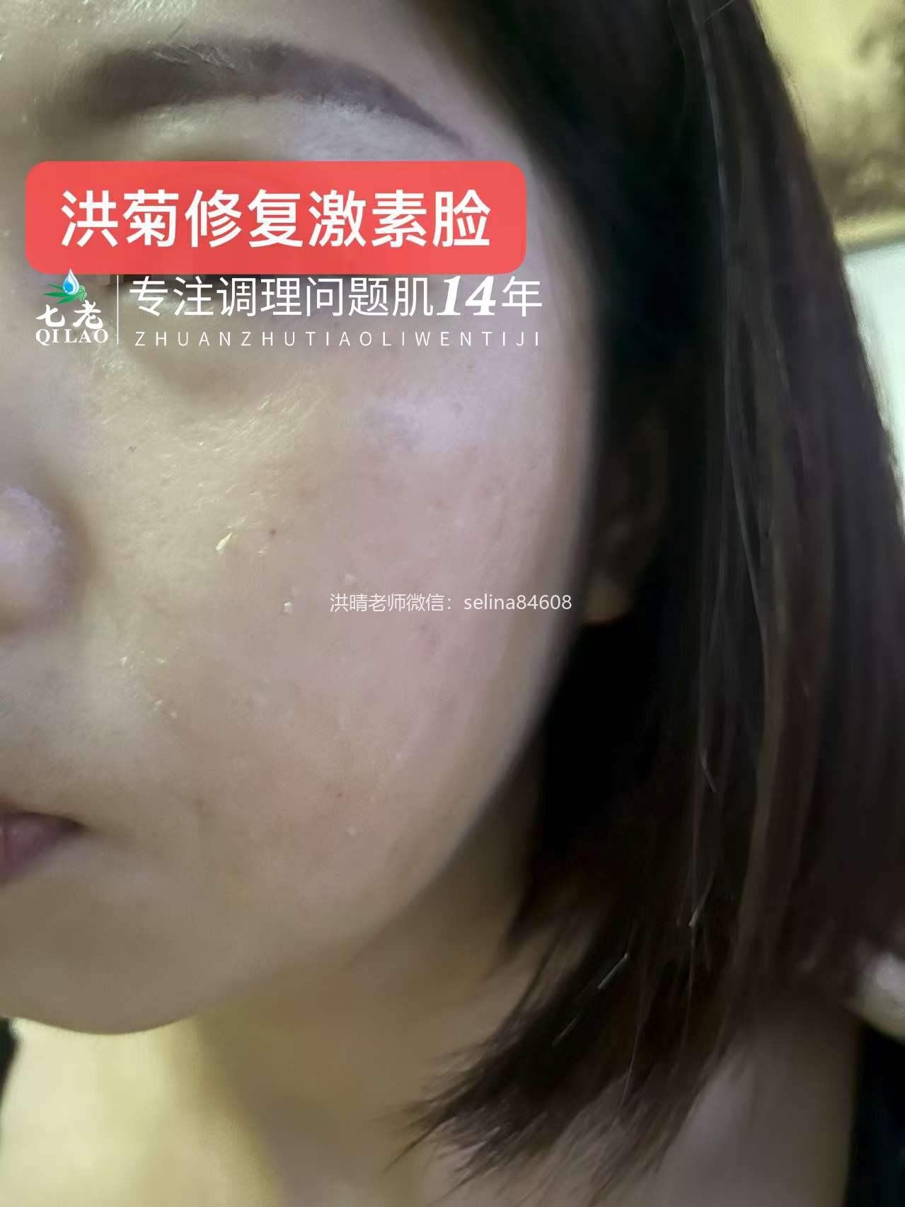 七老激素脸红烫痒流黄水结痂修护案例