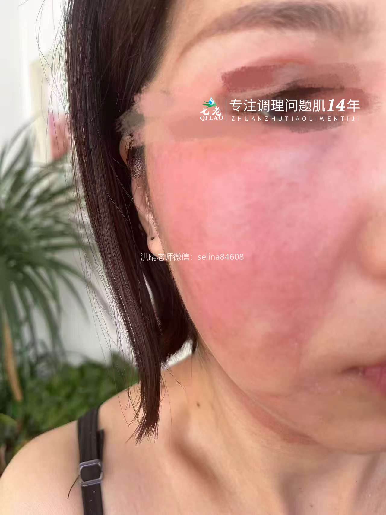 七老激素脸红烫痒流黄水结痂修护案例