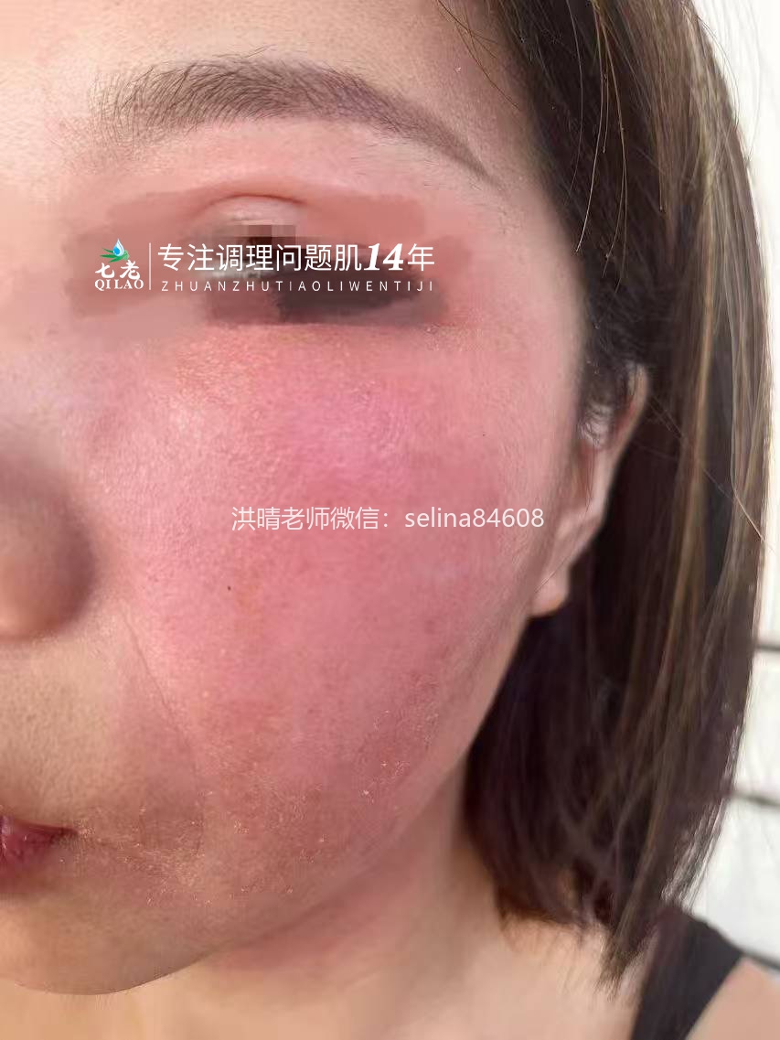七老激素脸红烫痒流黄水结痂修护案例