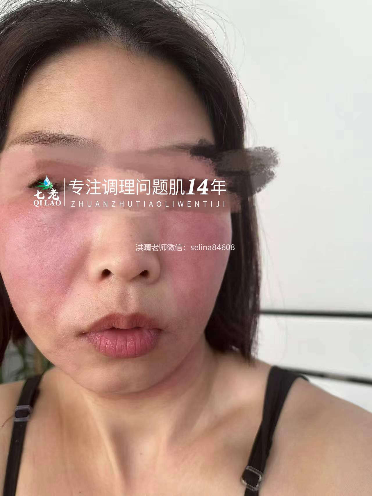 七老激素脸红烫痒流黄水结痂修护案例