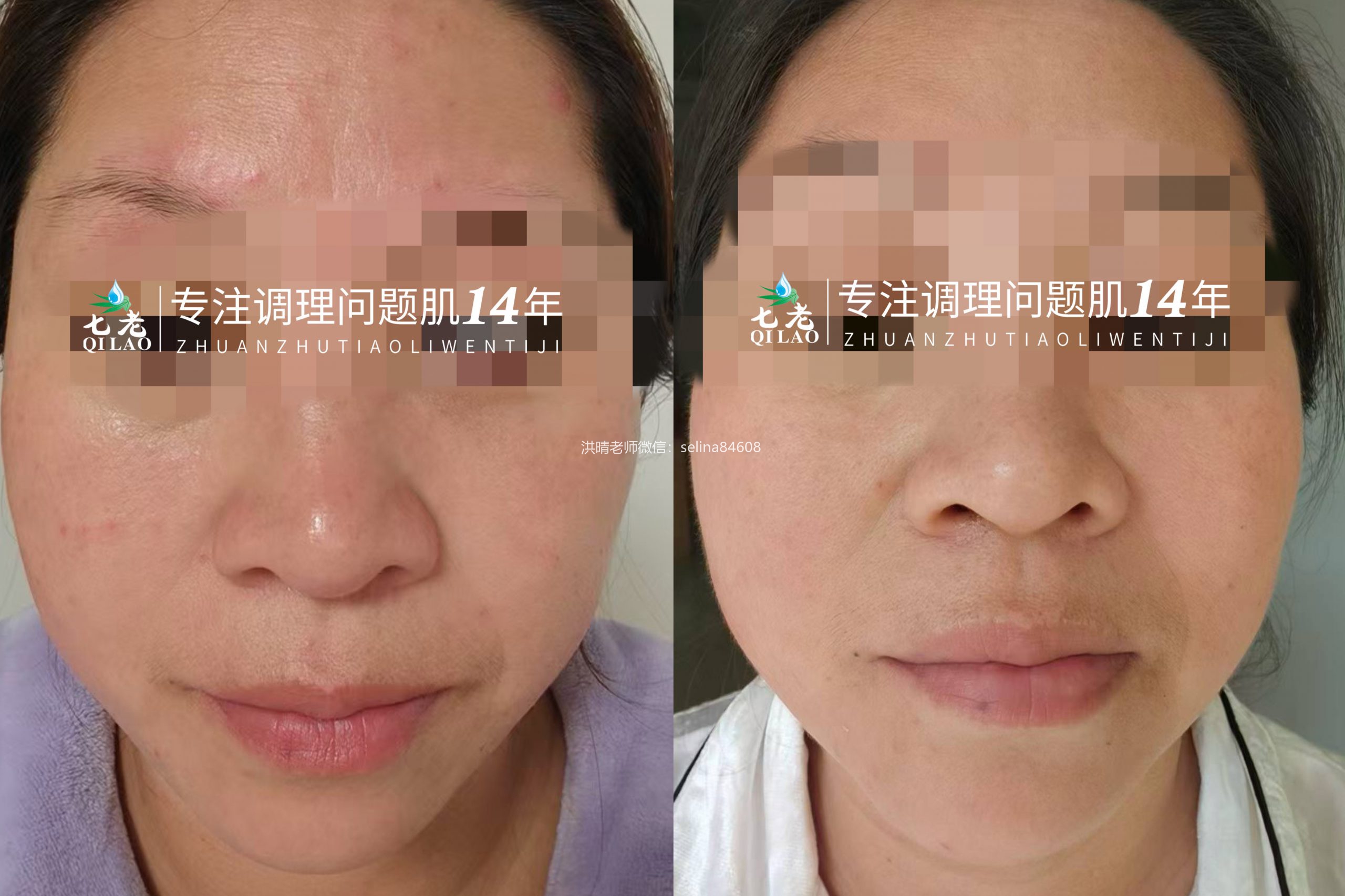 七老过敏性皮炎修护反馈