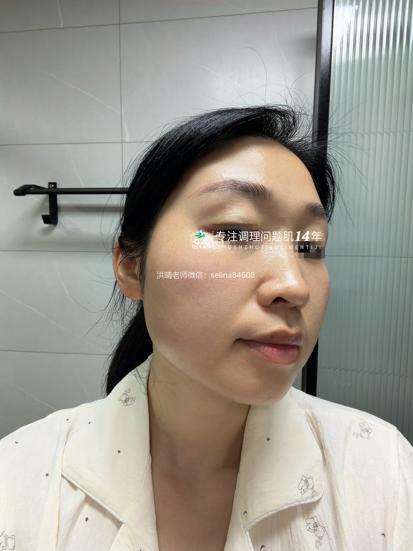 七老干红烫肿痒疹子疙瘩修护案例