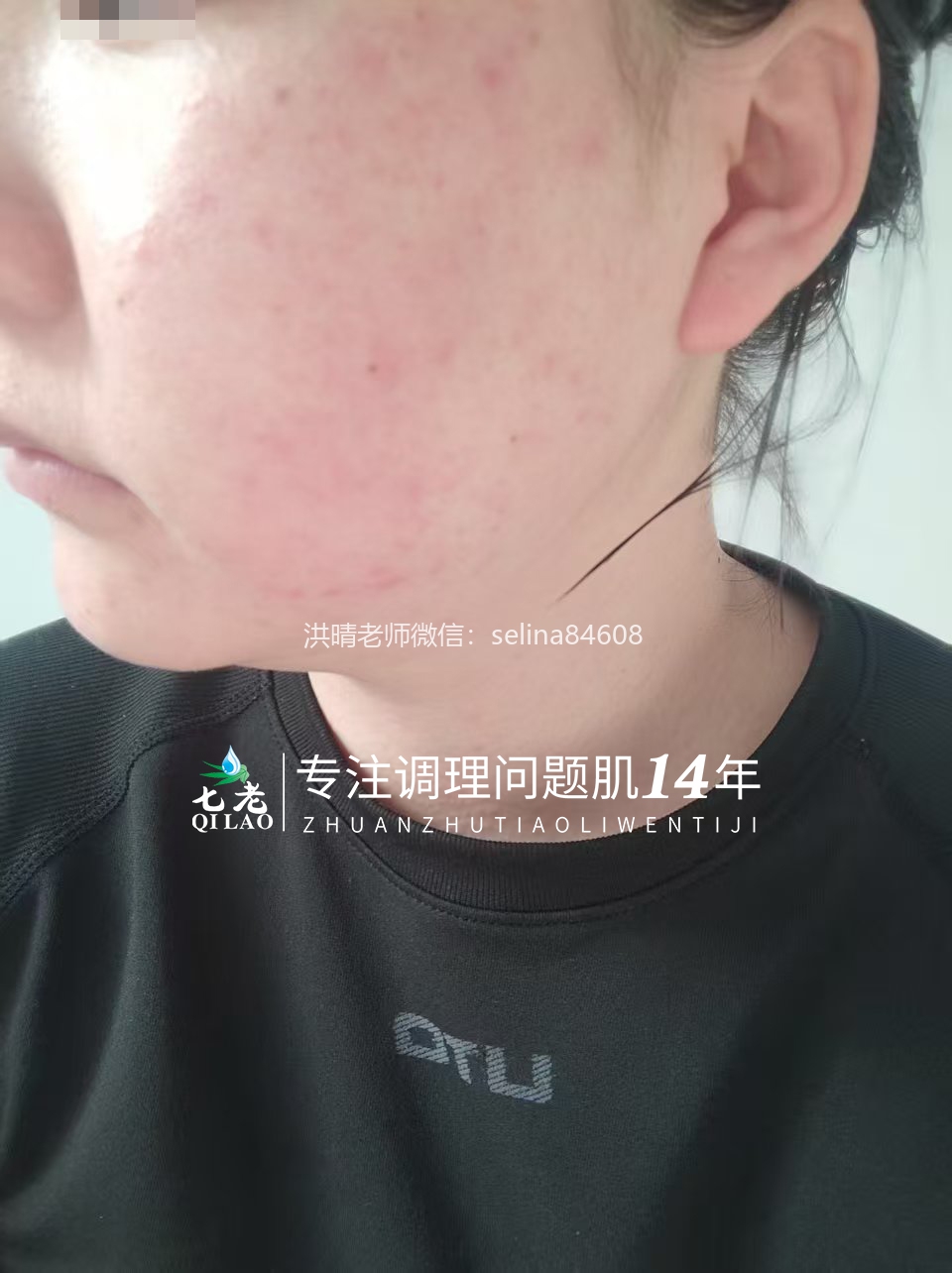 七老激素脸红烫痒疹子疙瘩修护案例