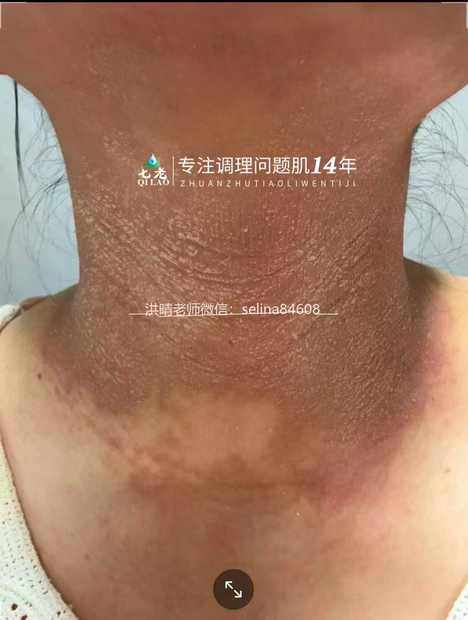 激素脸修护过程中脱皮怎么办？