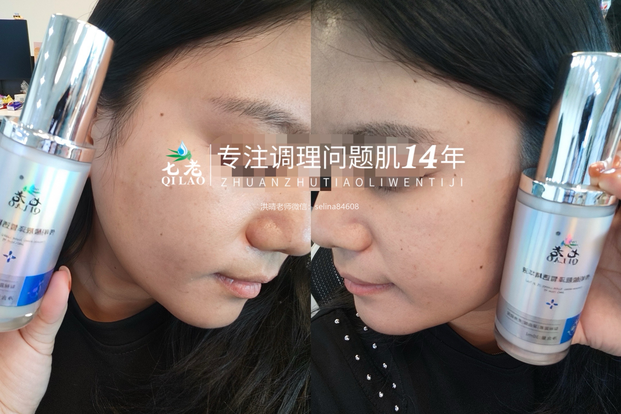七老痘痘肌痘印修护案例反馈