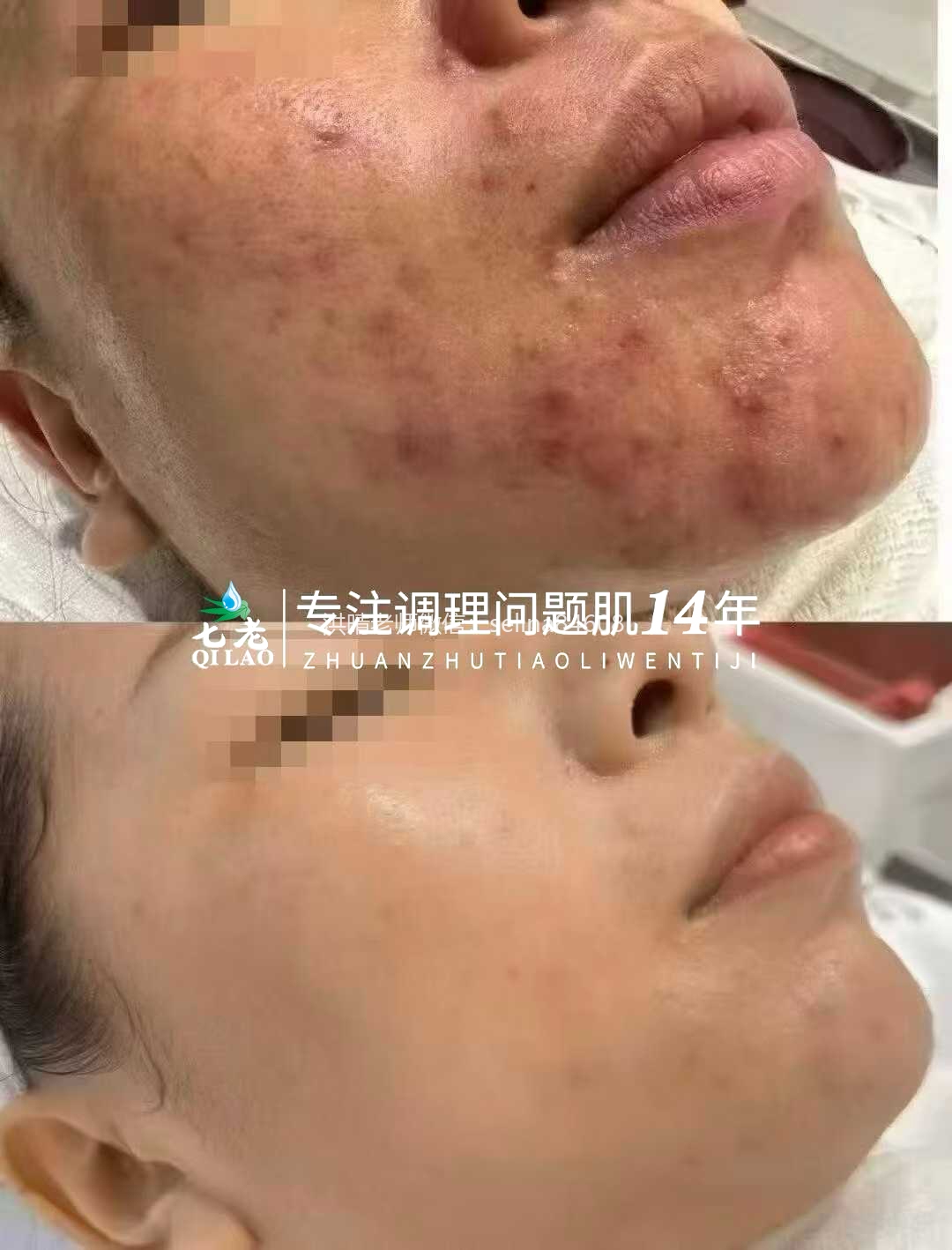 七老顽固粉刺炎性红痘痘修护案例
