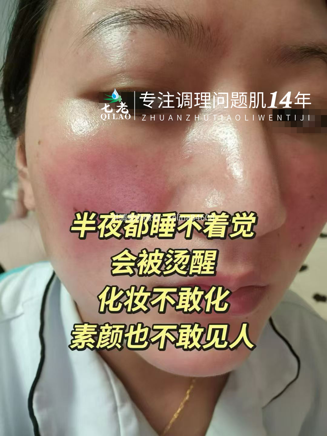 七老激素脸反复红肿烫痒疹子疙瘩修护案例