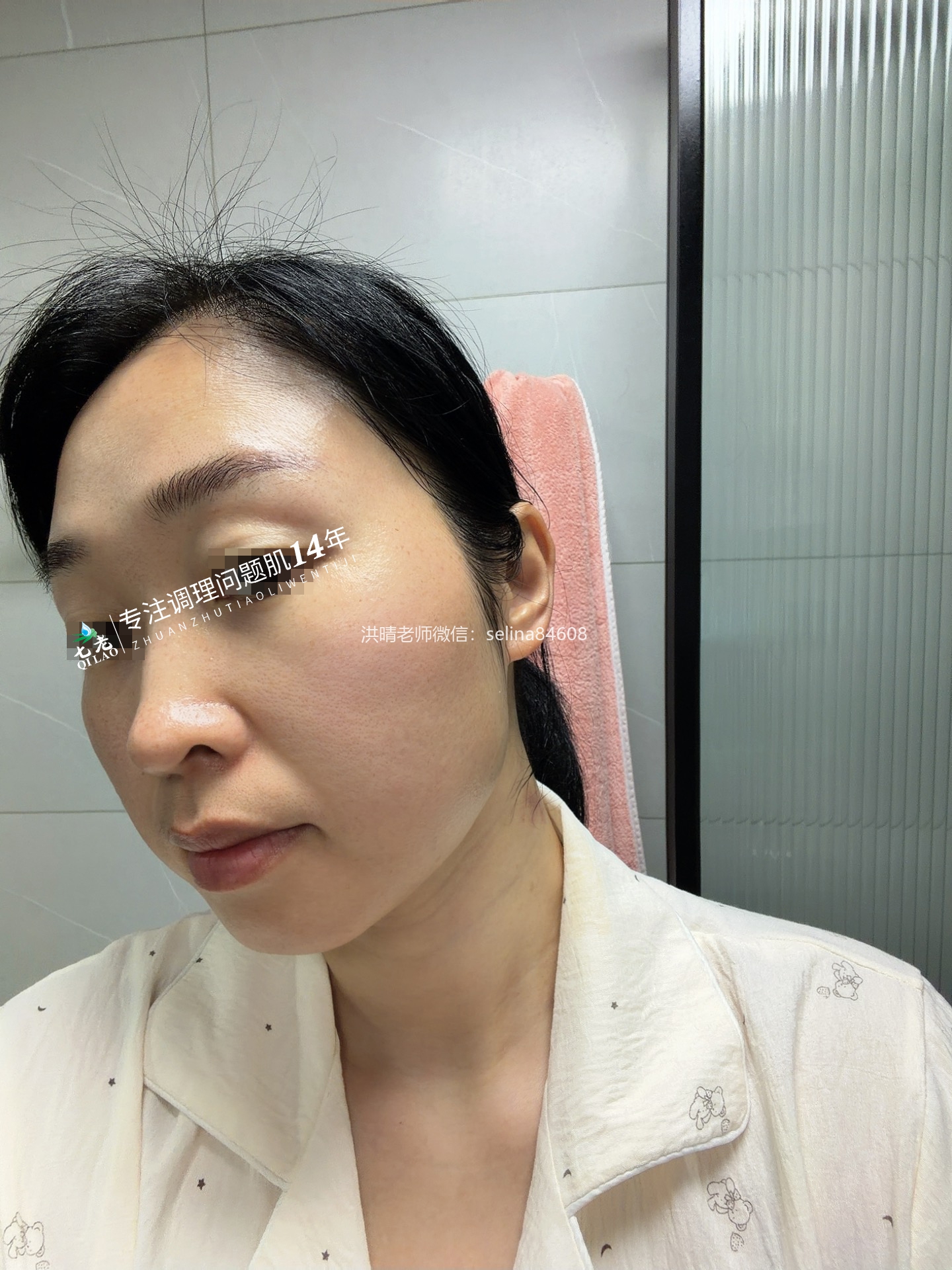 七老干红烫肿痒疹子疙瘩修护案例