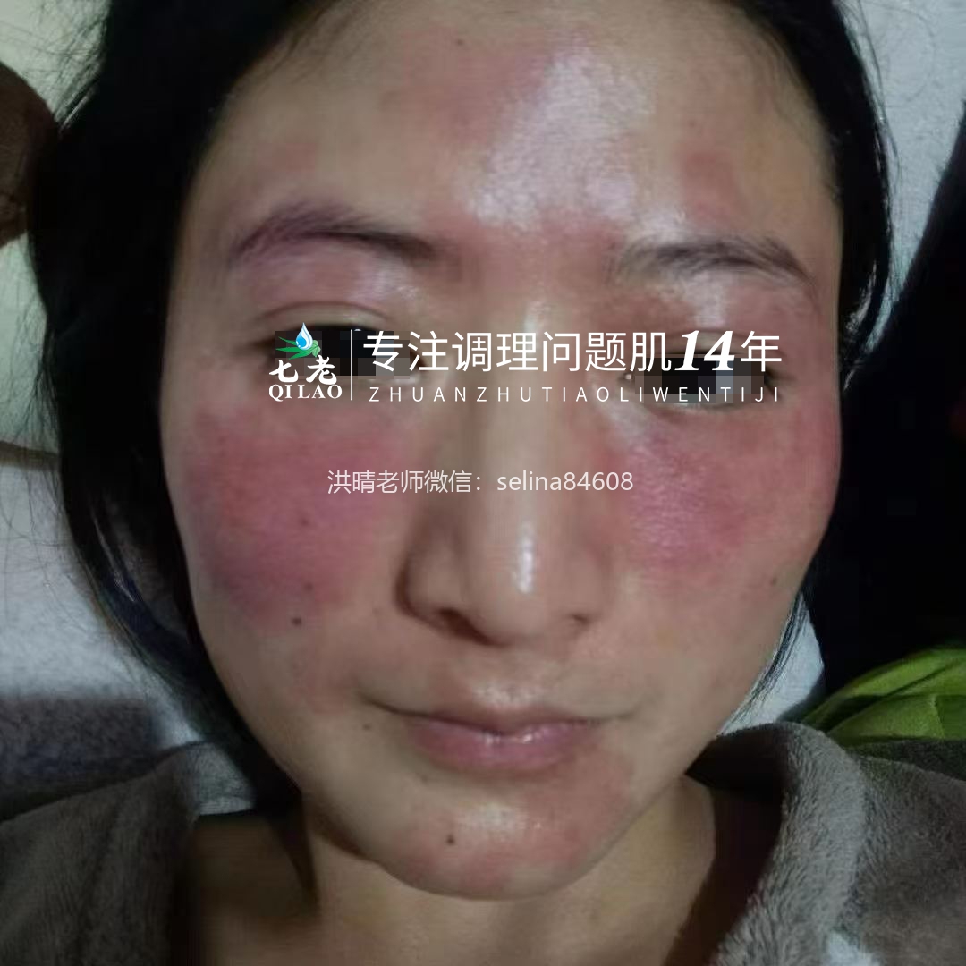 七老激素脸反复红肿烫痒疹子疙瘩修护案例