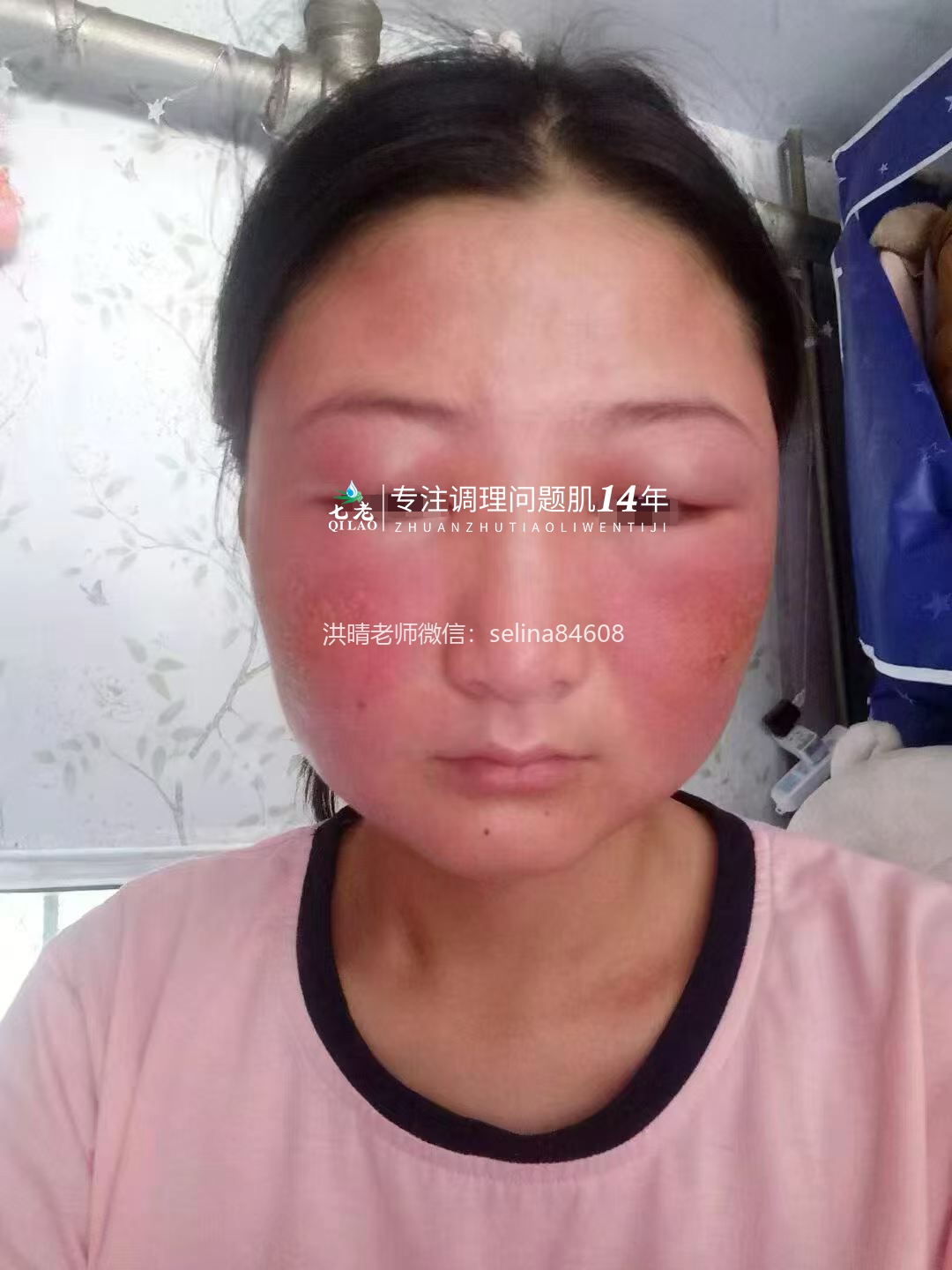 七老激素脸反复红肿烫痒疹子疙瘩修护案例