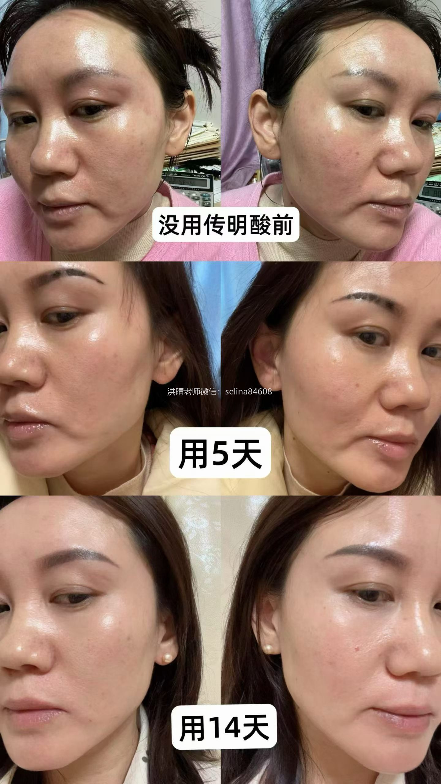 七老传明酸→黑红脸红黑脸色沉暗黄暗沉肤色不均
