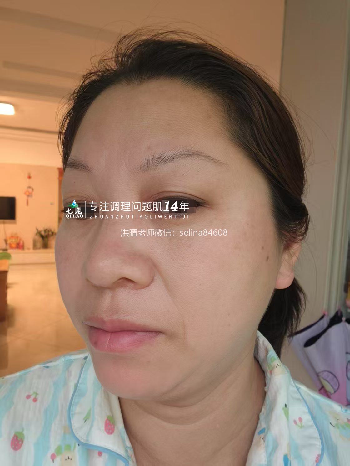 七老过敏性皮炎修护反馈