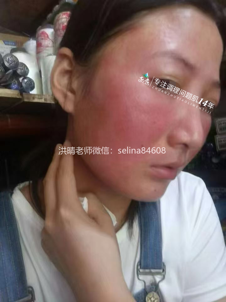 七老激素脸反复红肿烫痒疹子疙瘩修护案例