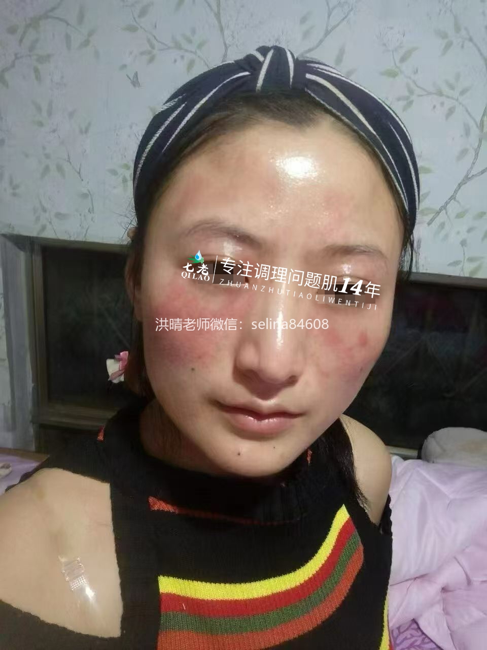 七老激素脸反复红肿烫痒疹子疙瘩修护案例