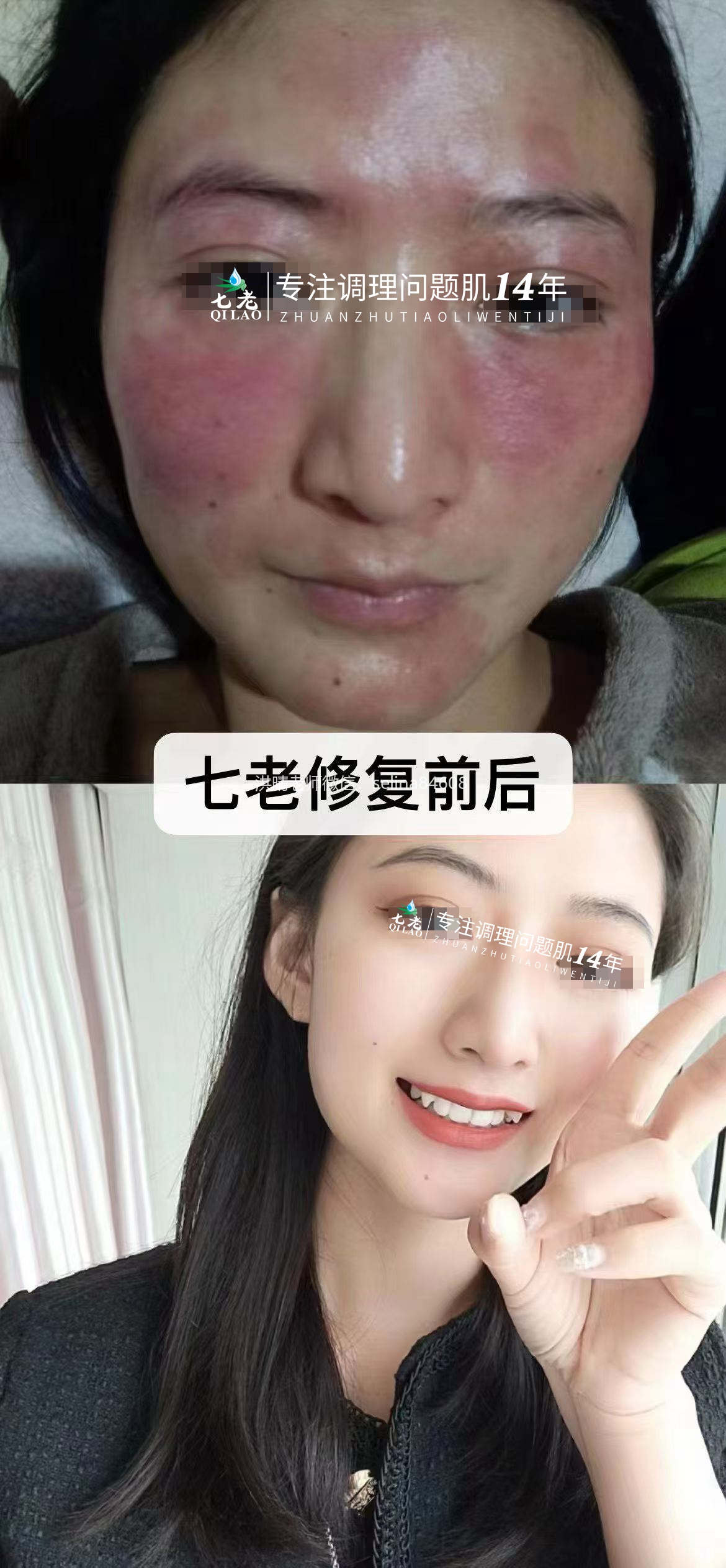 七老激素脸反复红肿烫痒疹子疙瘩修护案例