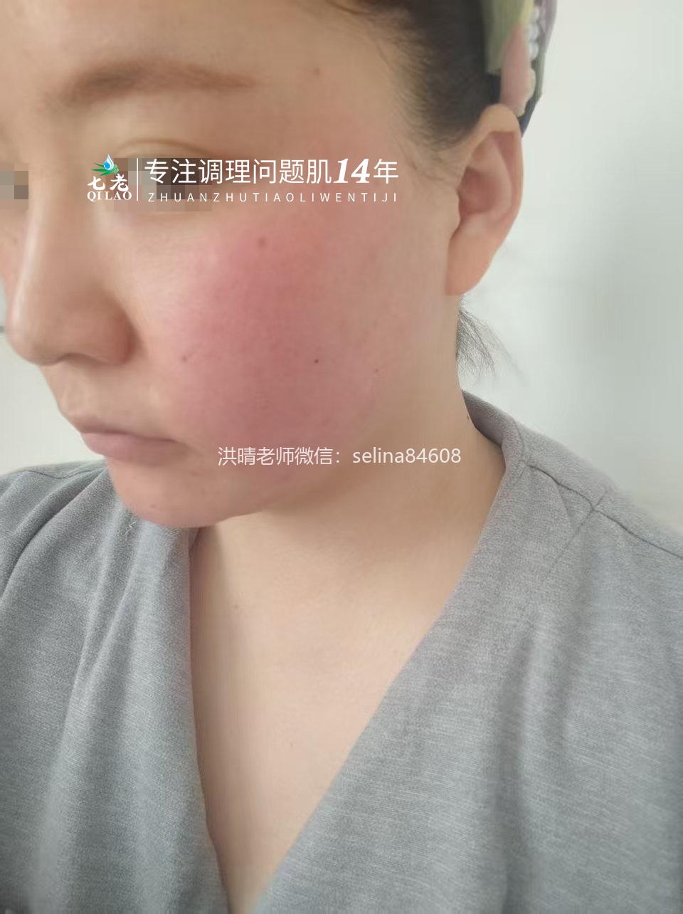 七老激素脸红烫痒疹子疙瘩修护案例